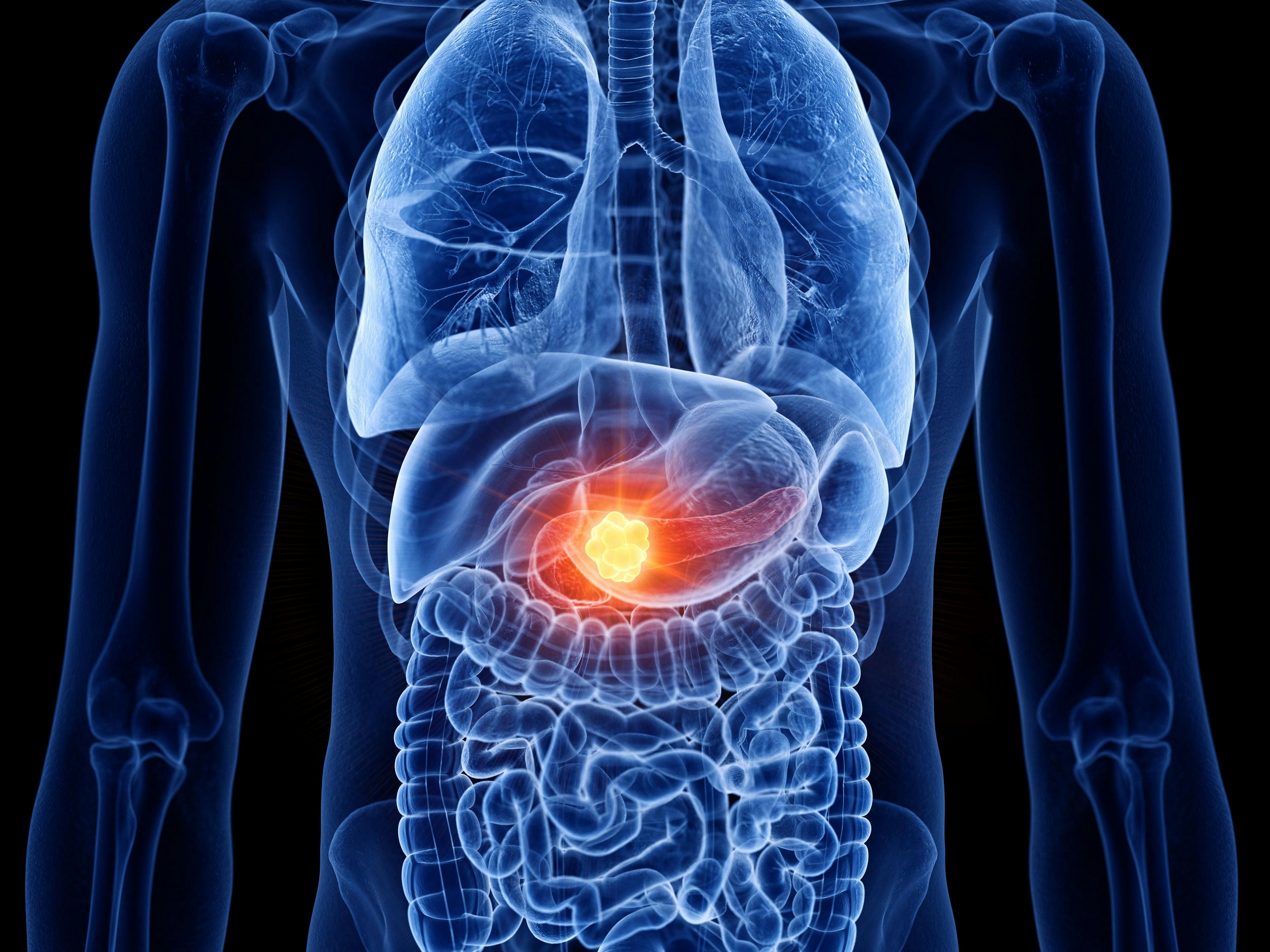 3d rendered medically accurate illustration of pancreas cancer - Image credit: Sebastian Kaulitzki | stock.adobe.com