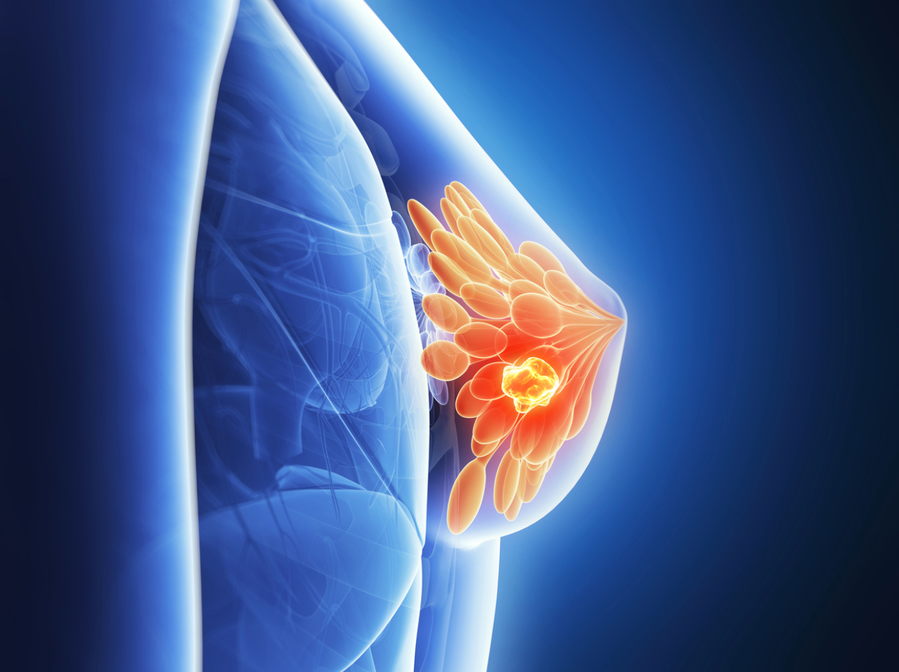 Overall Survival of Ibrance With Letrozole Numerically Longer Over Placebo for ER+, HER2- Metastatic Breast Cancer 