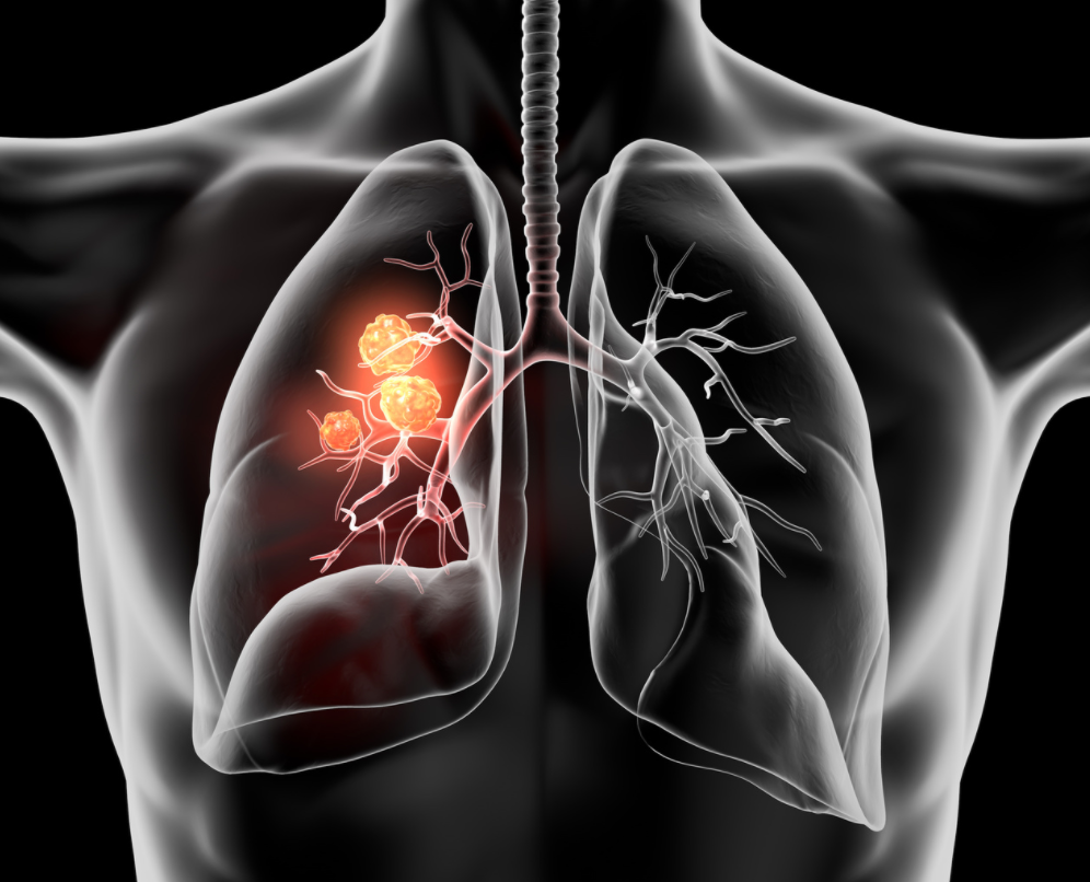 Combination Therapy Shows Significant Response Rates in Advanced NSCLC