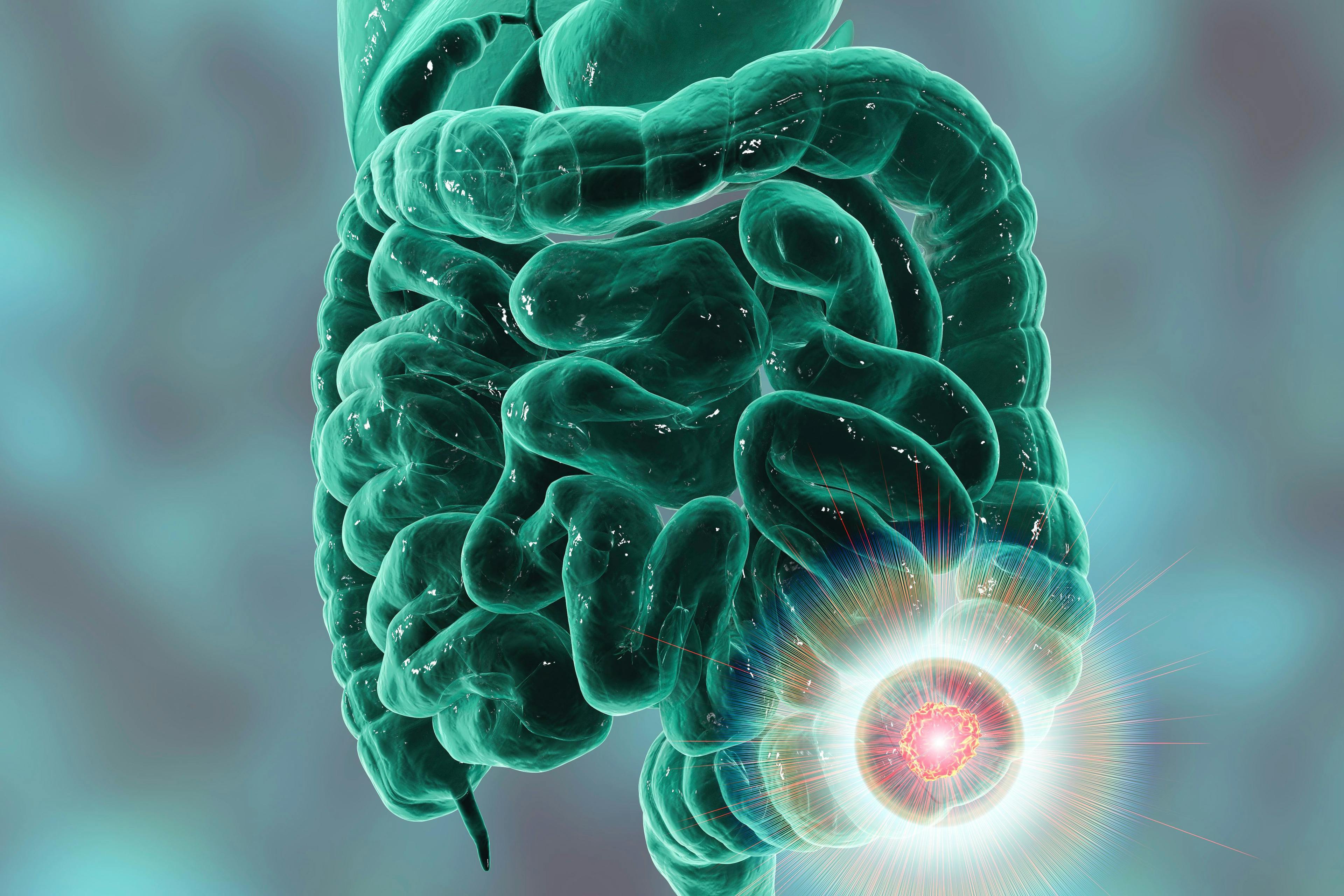 Colorectal cancer awareness medical concept. Concept of cancer treatment and prevention, 3D illustration - Image credit: Dr_Microbe | stock.adobe.com