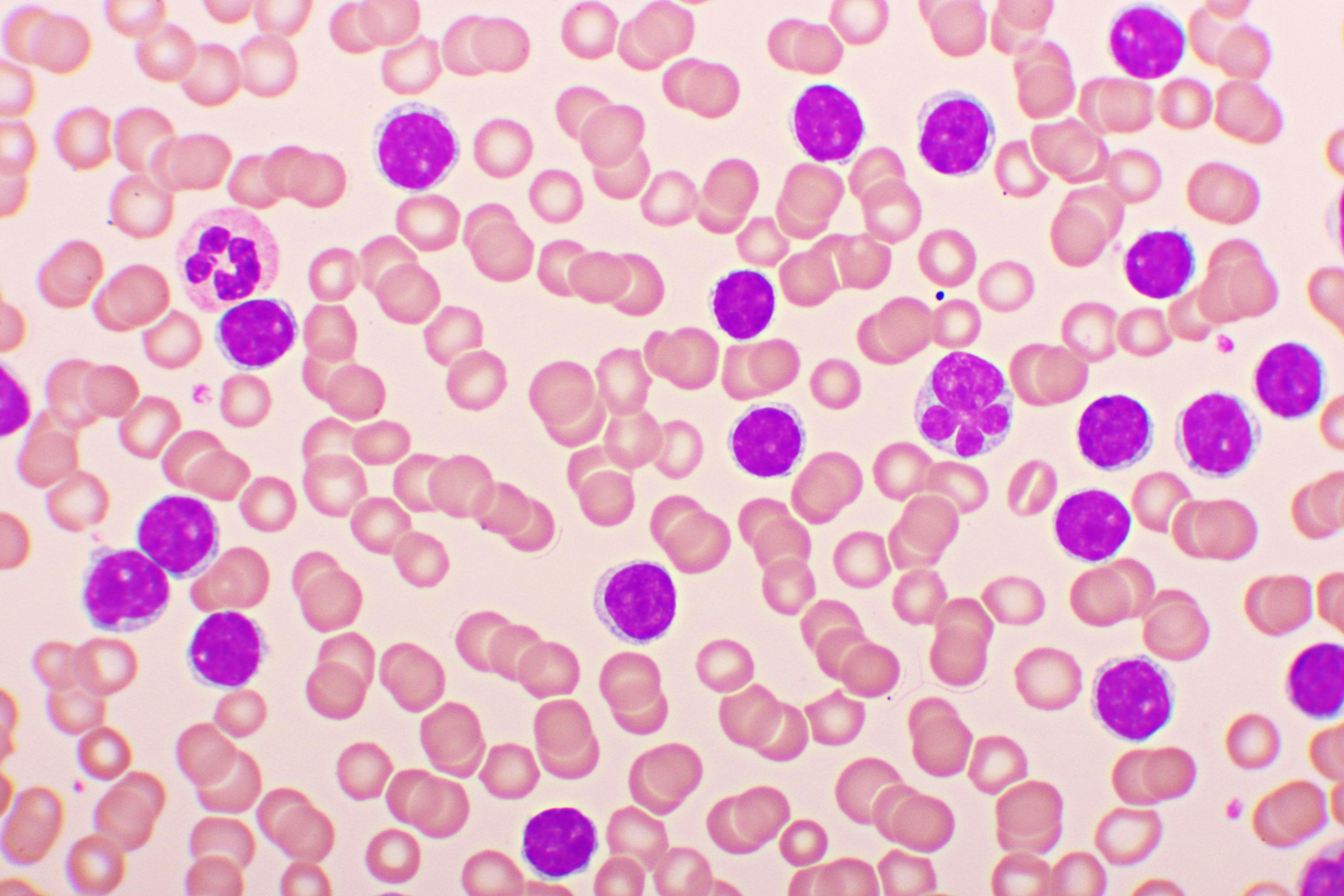 Microscopic view of acute lymphocytic leukemia cells -- Image credit: jarun011 | stock.adobe.com