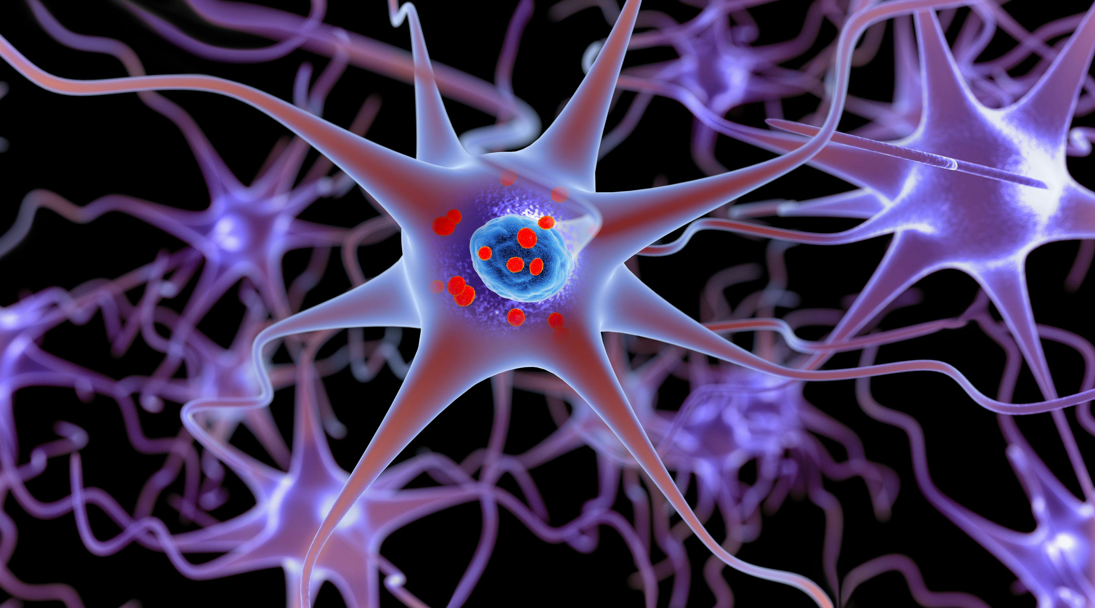 Parkinson's disease. 3D illustration showing neurons containing Lewy bodies small red spheres which are deposits of proteins (alpha-synuclein) accumulated in the brain cells