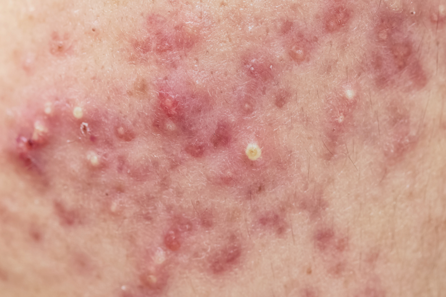 Pharmacy Clinical Pearl of the Day: Psoriasis