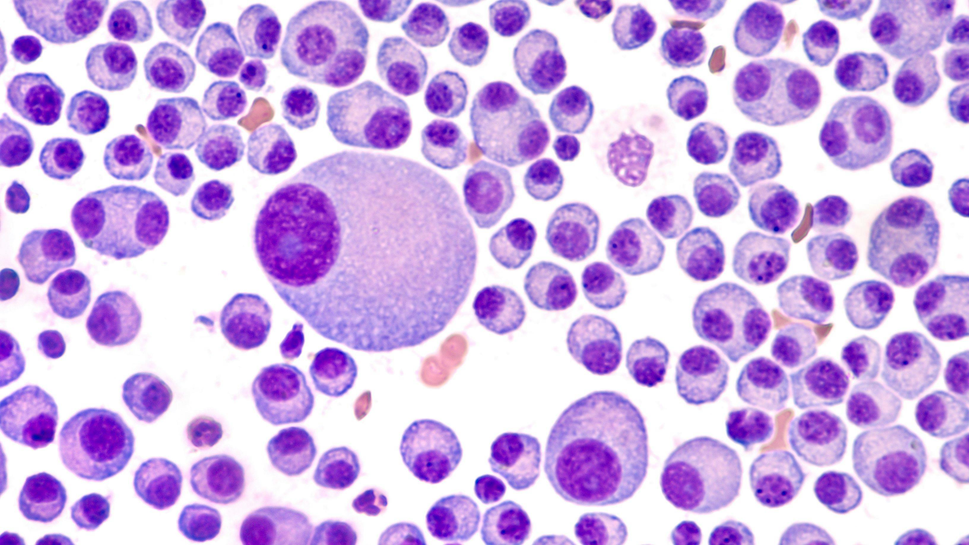 Multiple myeloma, a type of bone marrow cancer of malignant plasma cells -- Image credit: David A Litman | stock.adobe.com