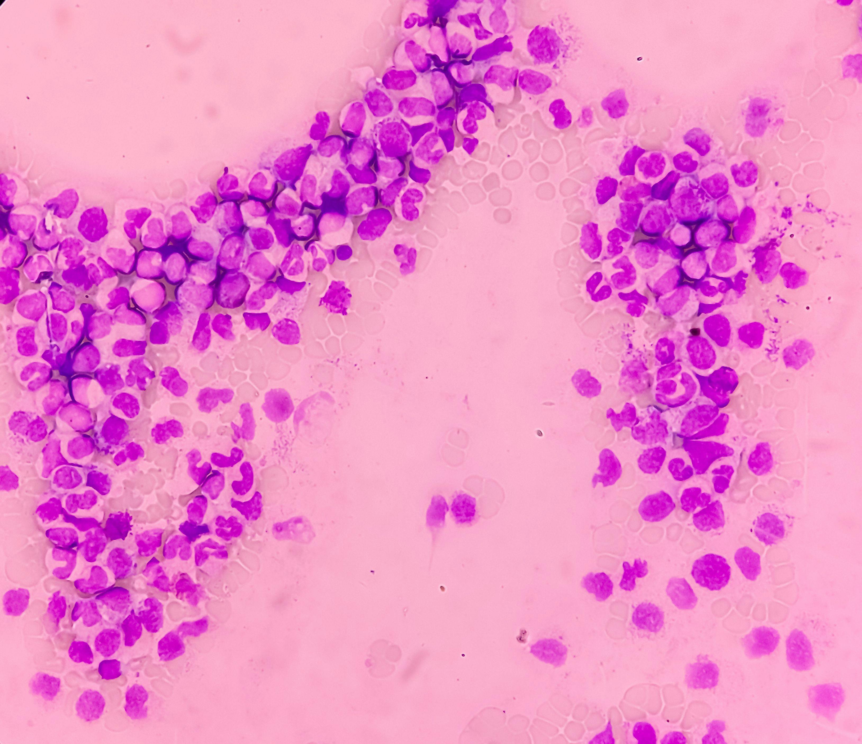 Microscopic view of chronic myeloid leukemia cells