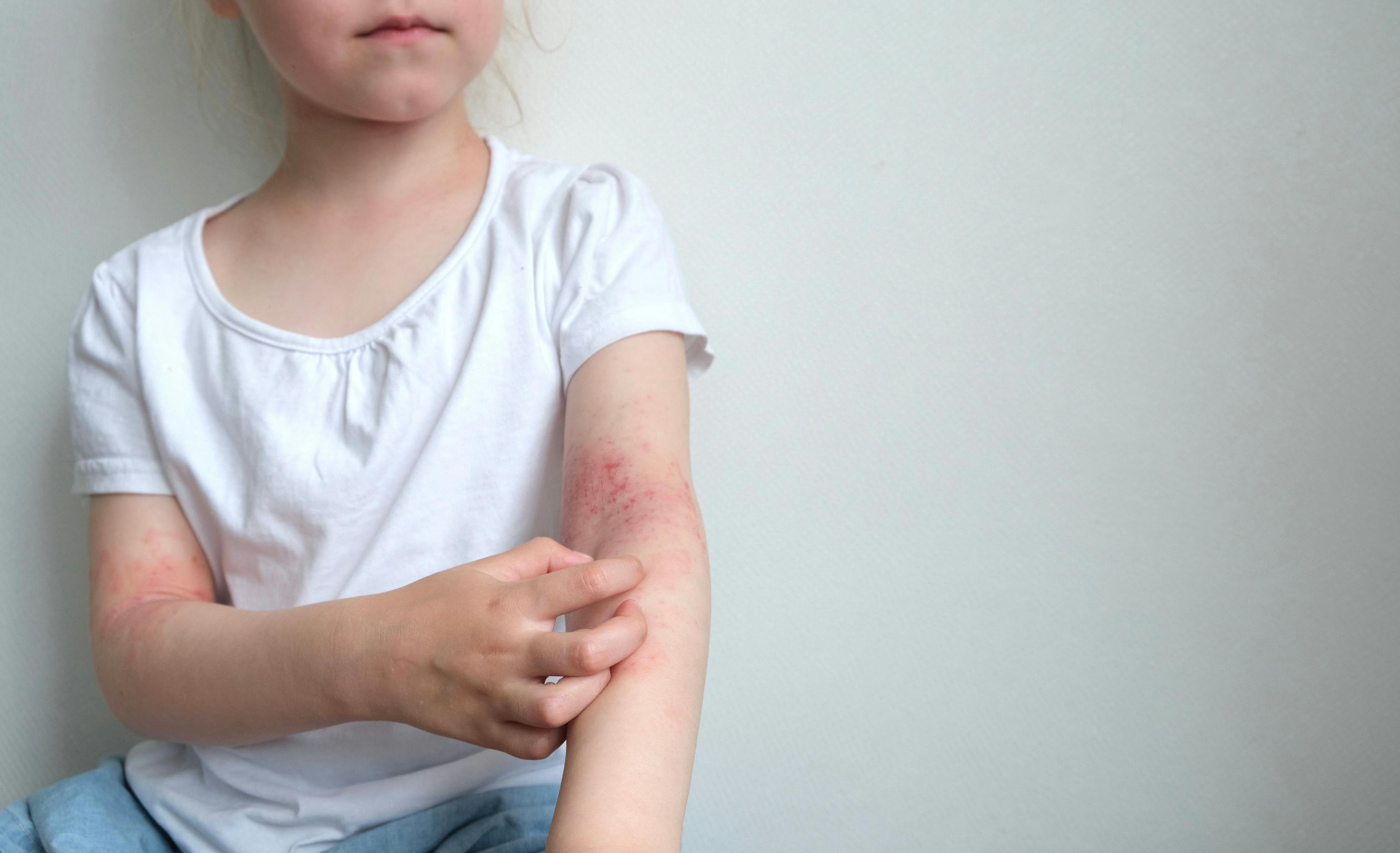 The child scratches atopic skin. Dermatitis, diathesis, allergy on the child's body - Image credit: Марина Терехова | stock.adobe.com