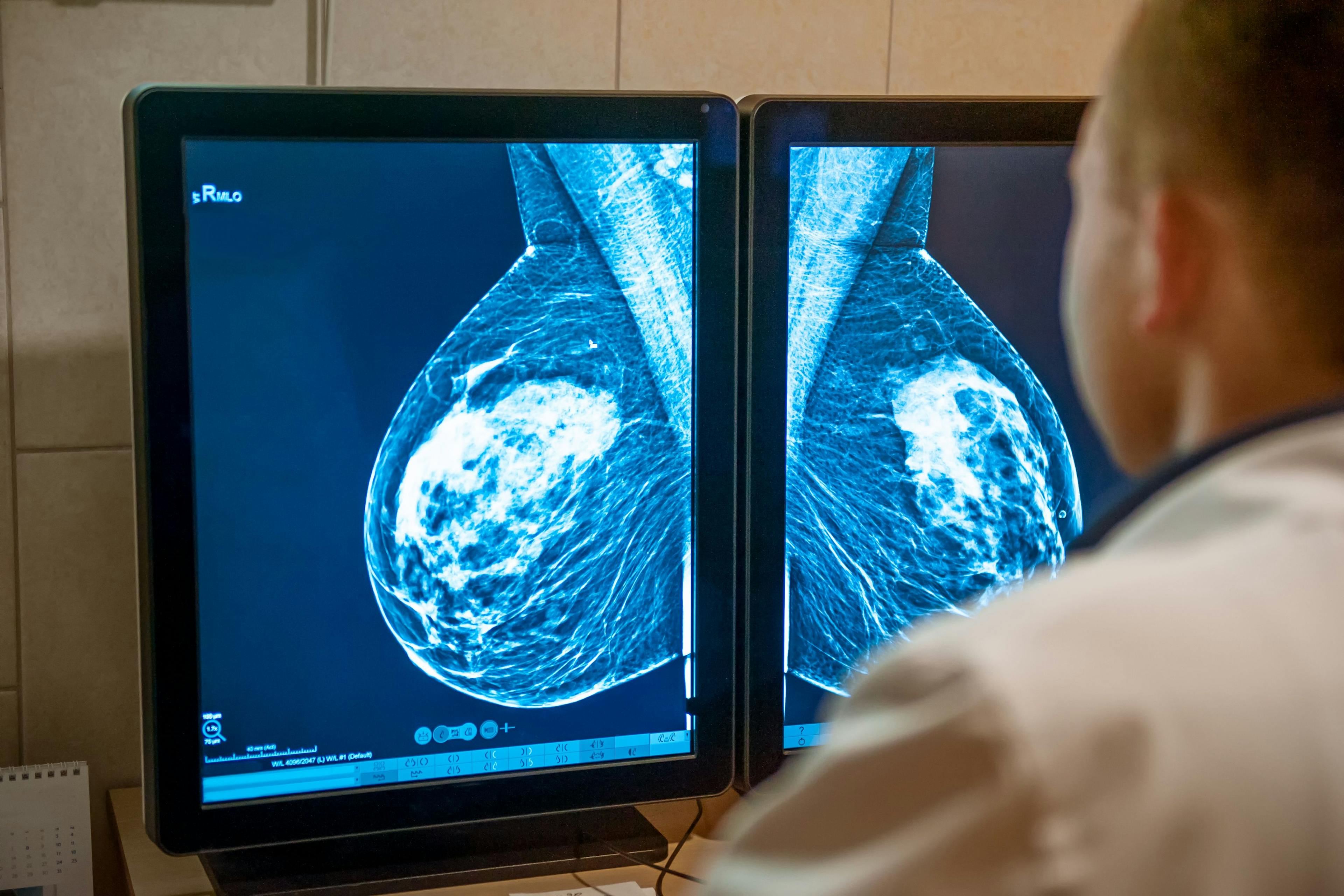 Doctor examines mammogram of patient on the monitors. | Image Credit: okrasiuk - stock.adobe.com