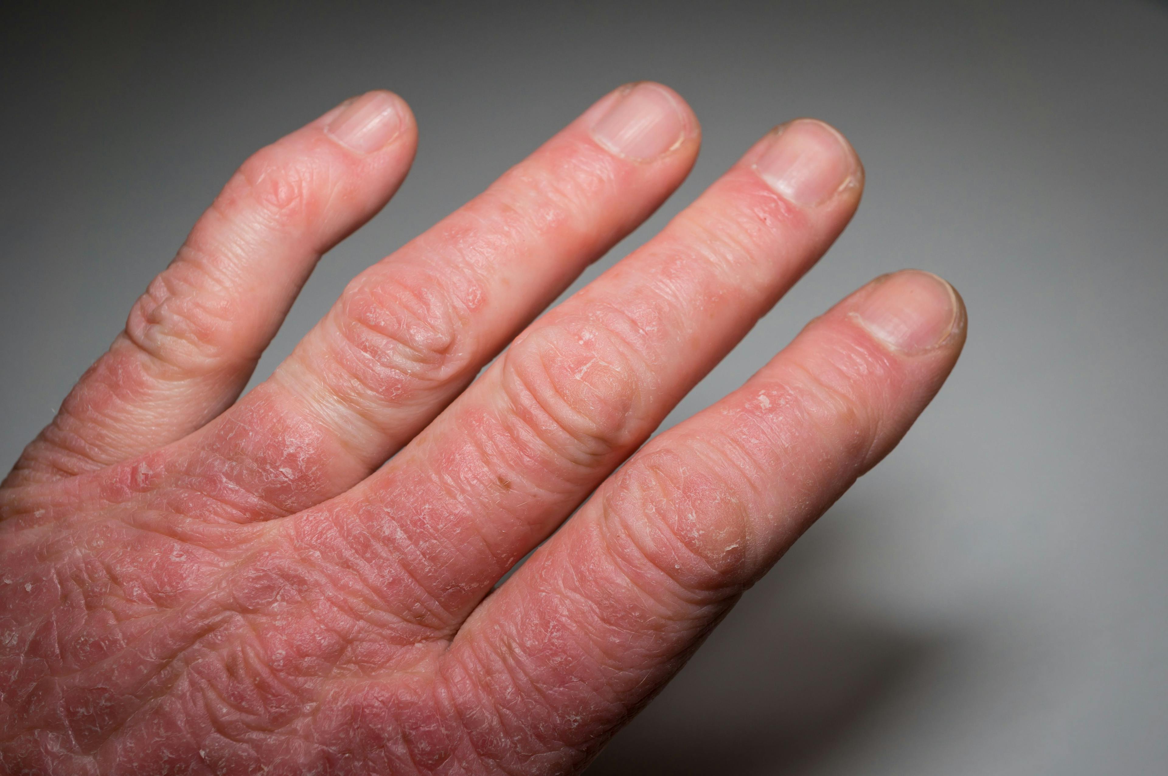 Upadacitinib Receives FDA Approval for Treatment of Active Psoriatic Arthritis