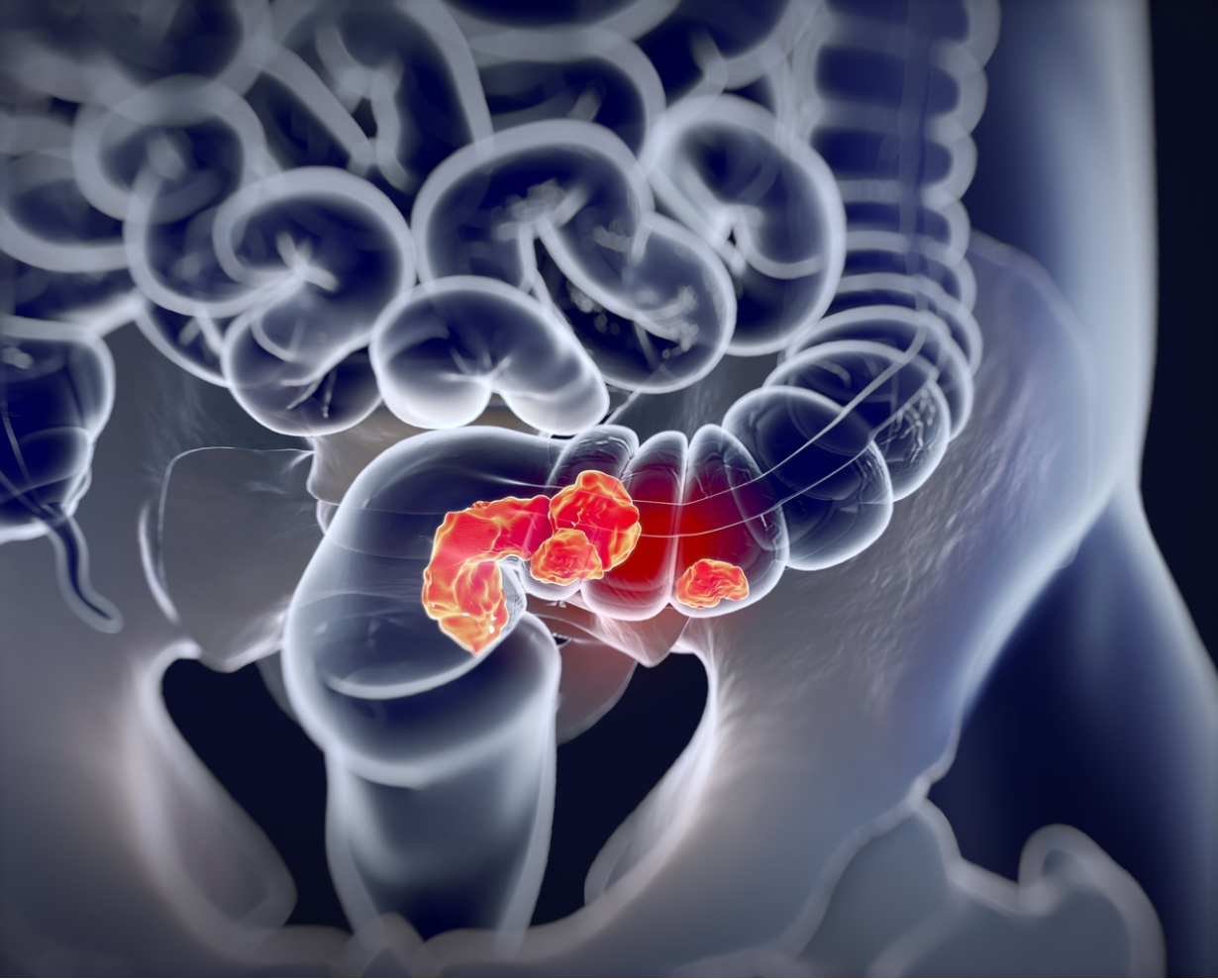 Patients at Average Risk of Colorectal Cancer May Prefer Stool-Based Screenings