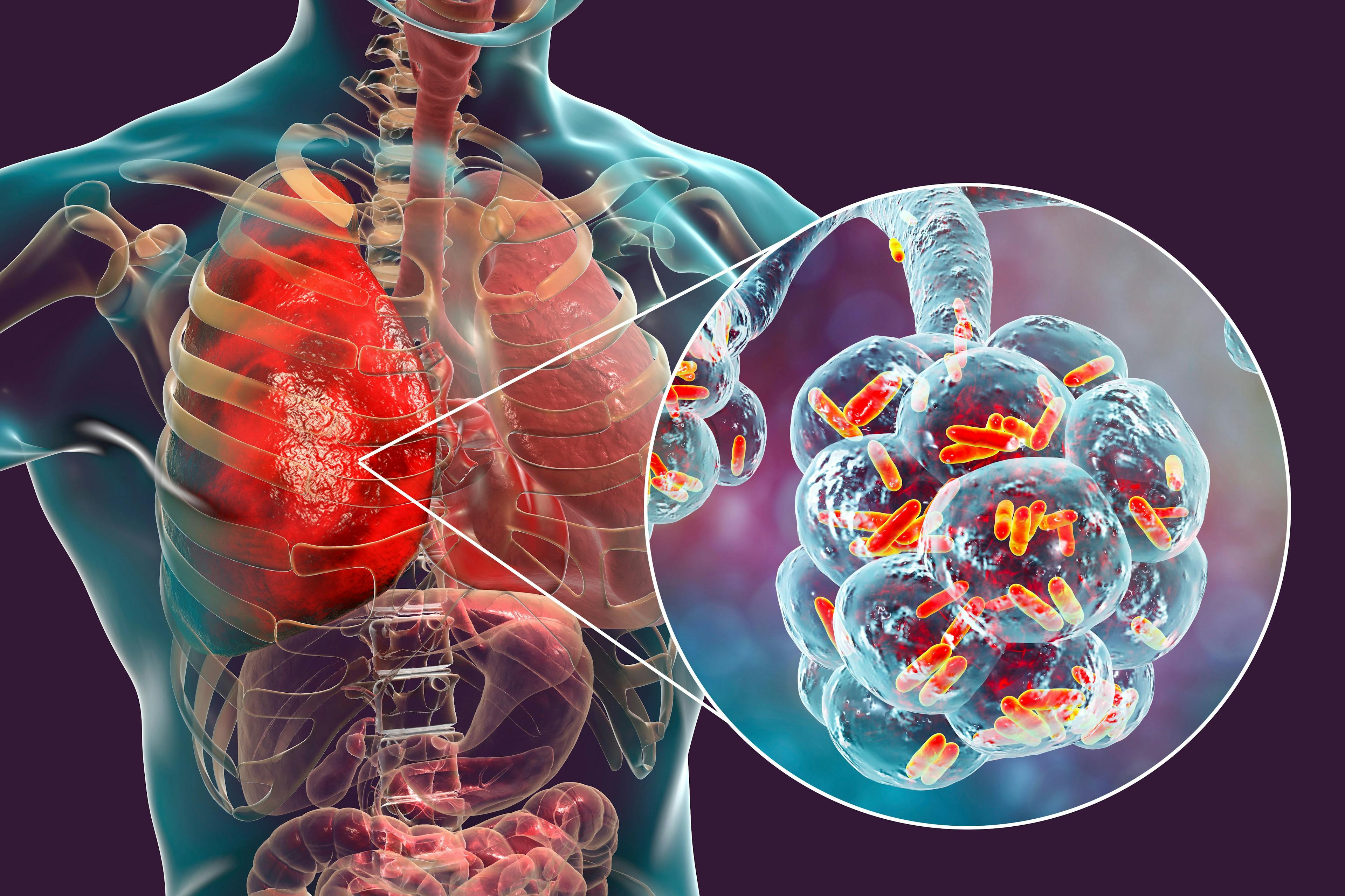 3D illustration showing rod-shaped bacteria inside alveoli of the lung | Image Credit: Dr_Microbe - stock.adobe.com