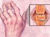 TNF-Inhibitors Decrease Risk of Myocardial Infarction in Rheumatoid Arthritis Patients