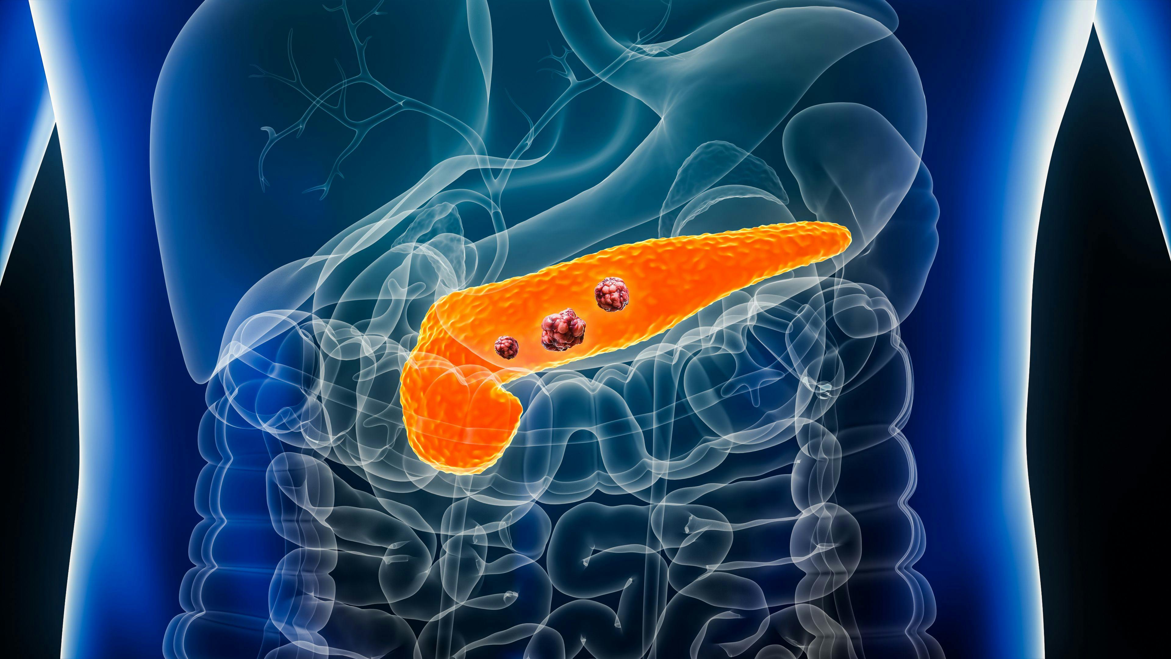Pancreas or pancreatic cancer with organs and tumors or cancerous cells 3D rendering illustration with male body. Anatomy, oncology, disease, medical, biology, science, healthcare concepts- Image credit: Matthieu | stock.adobe.com