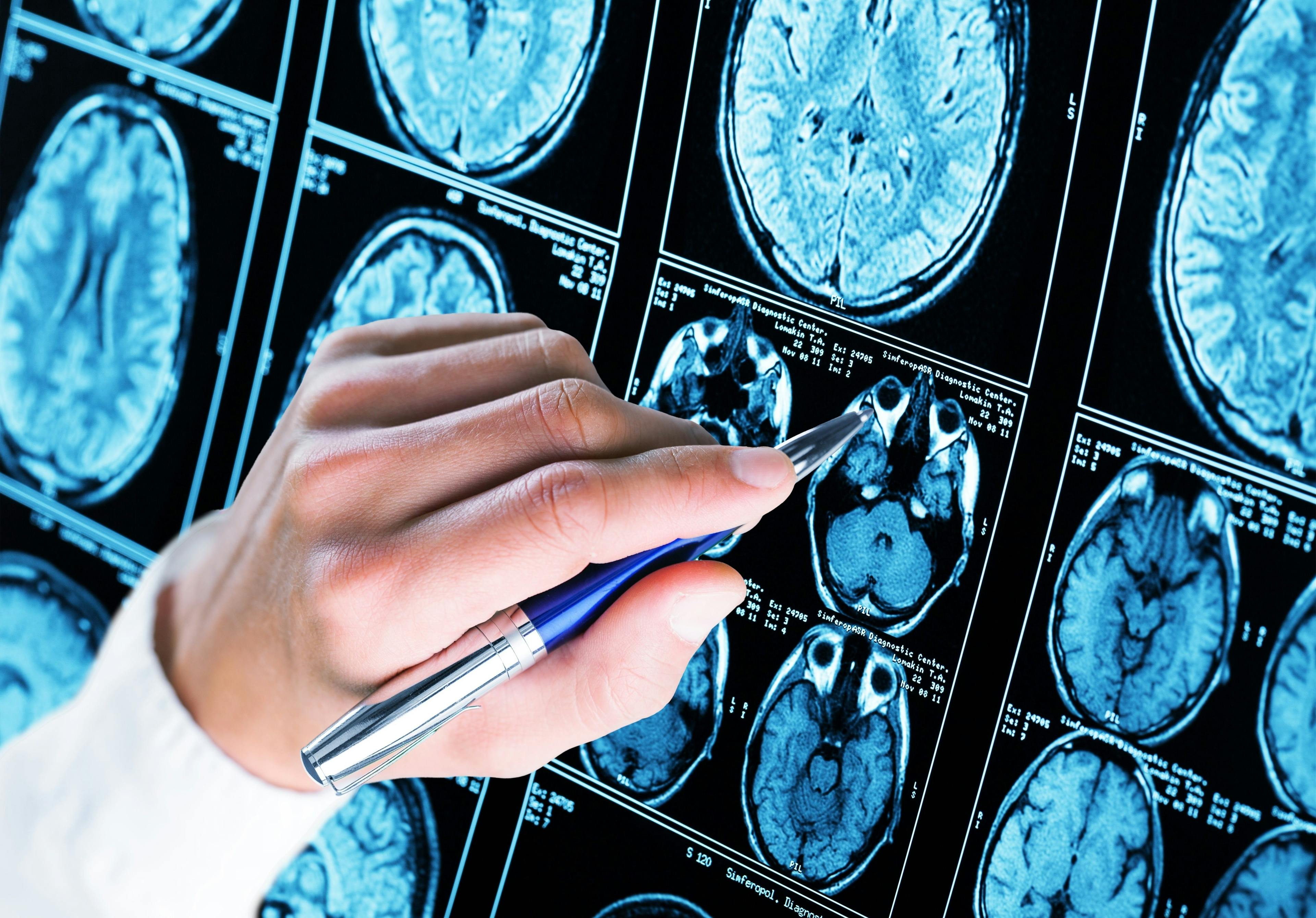 Physician examining brain scans, neurology images