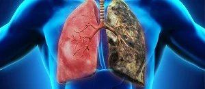 Study: Patients With Lung Cancer Had Higher Levels of Anxiety Due to COVID-19