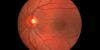 No Recommendation on Benefits and Harms of Glaucoma Screening