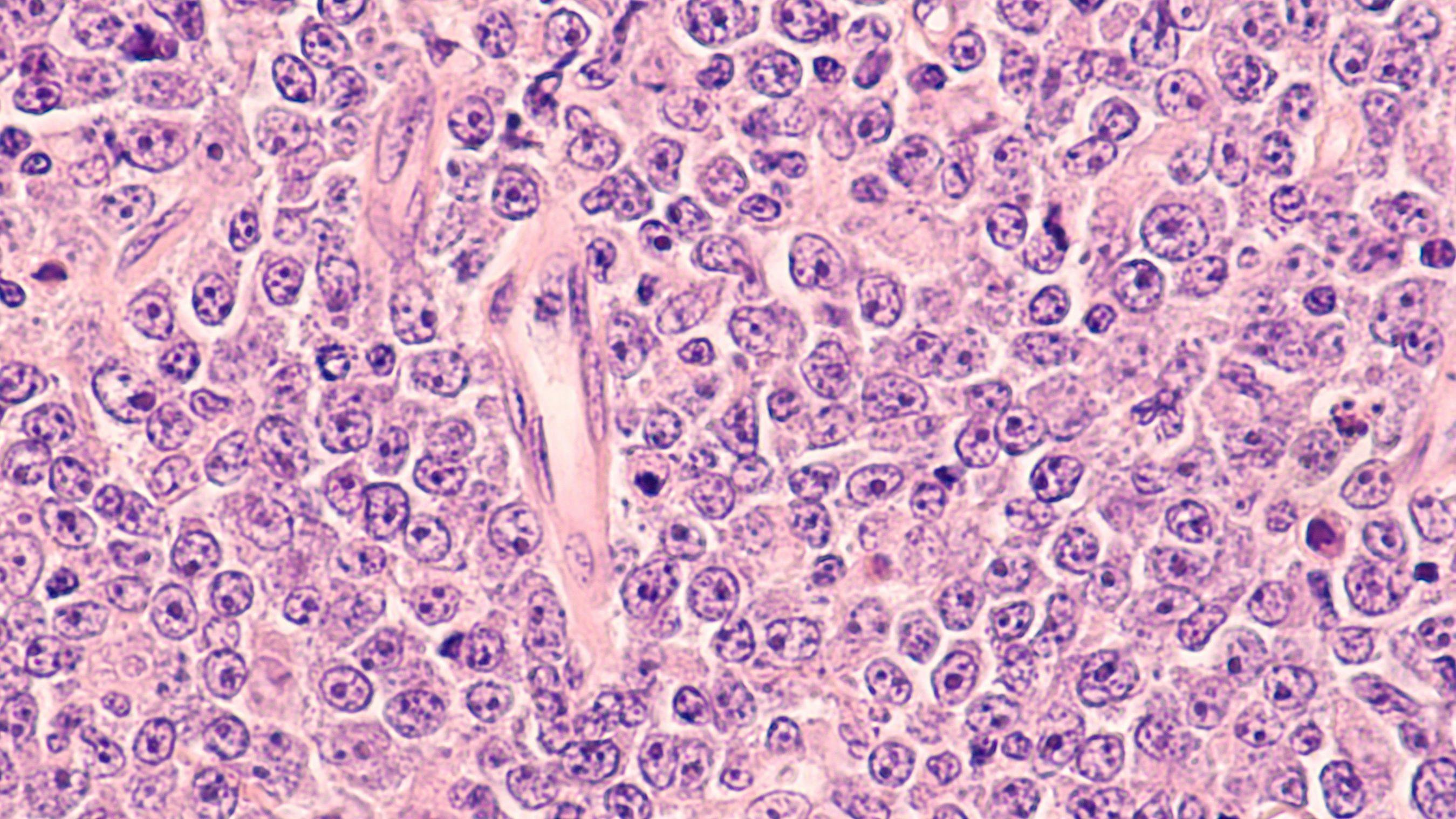 Lymphoma awareness: photomicrograph of a diffuse large B-cell lymphoma (DLBCL) a type of non-Hodgkin lymphoma. This case is from the testis of an elderly man and shows prominent nucleoli. Credit: David A Litman - stock.adobe.com.