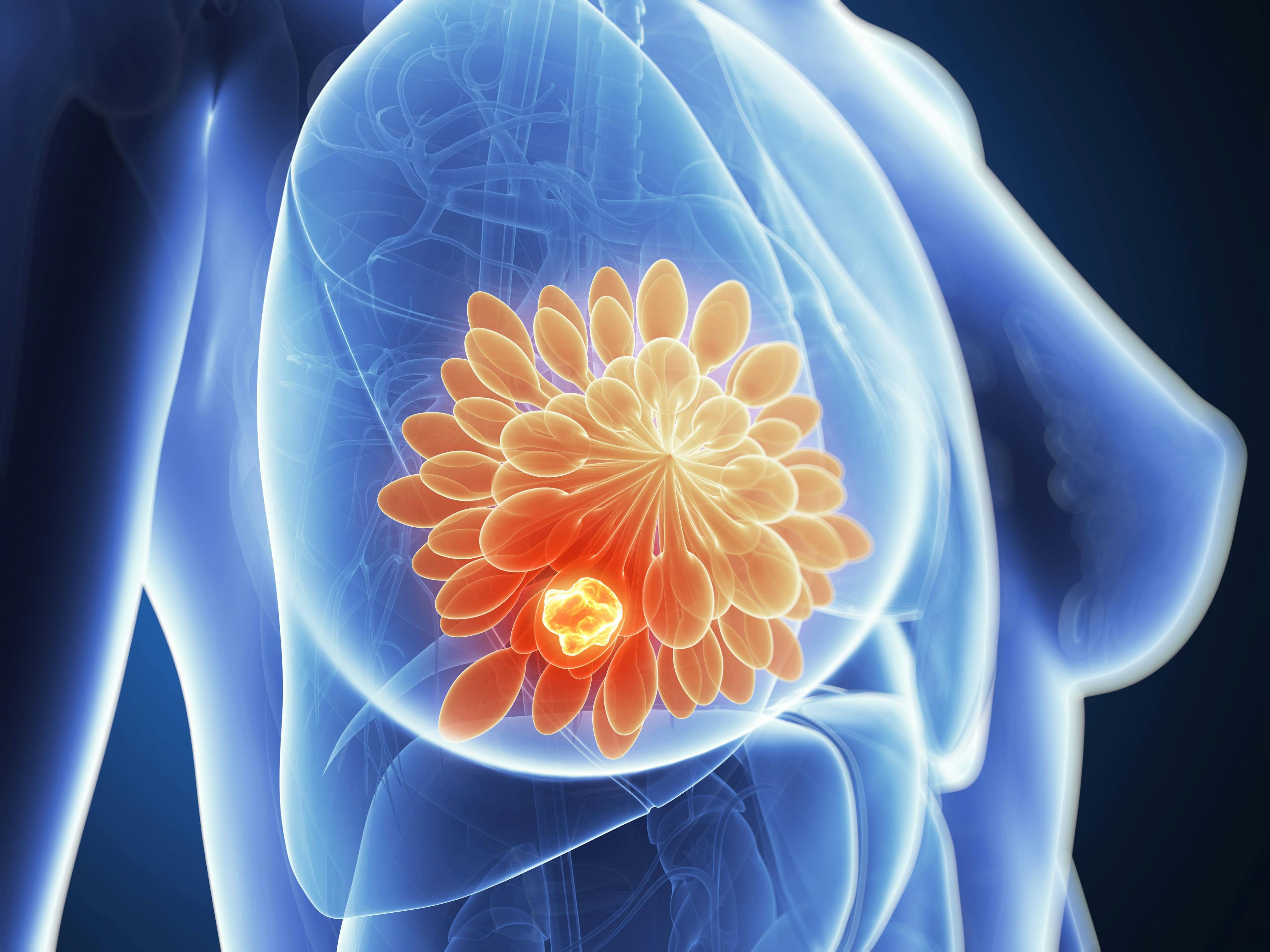 Study: Patients With PD-L1-Positive, High-Risk, ER+/HER2- Breast Cancer Can Achieve Substantial Complete Response Rates With Addition of Nivolumab