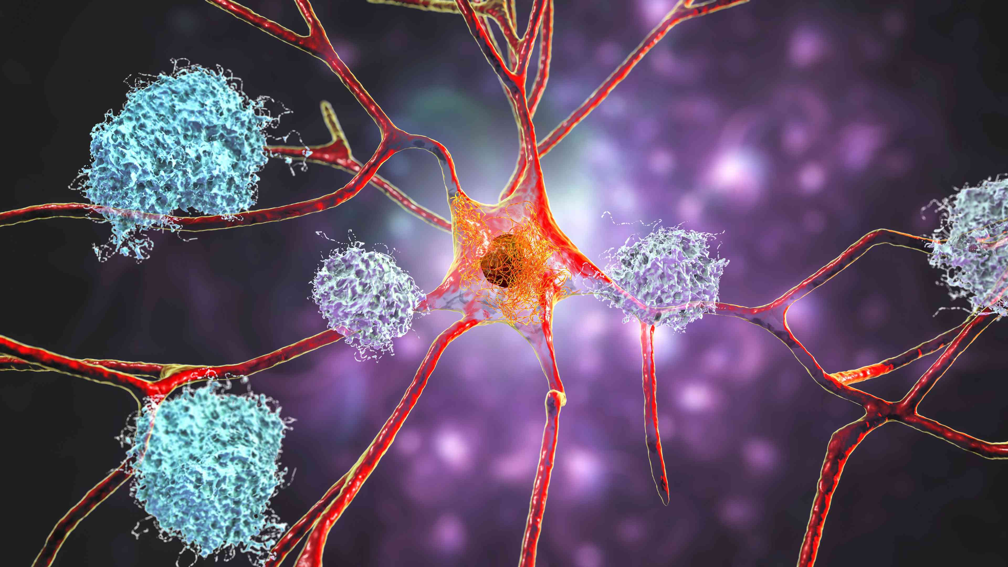 Amyloid plaques in brain -- Image credit: Dr_Microbe | stock.adobe.com