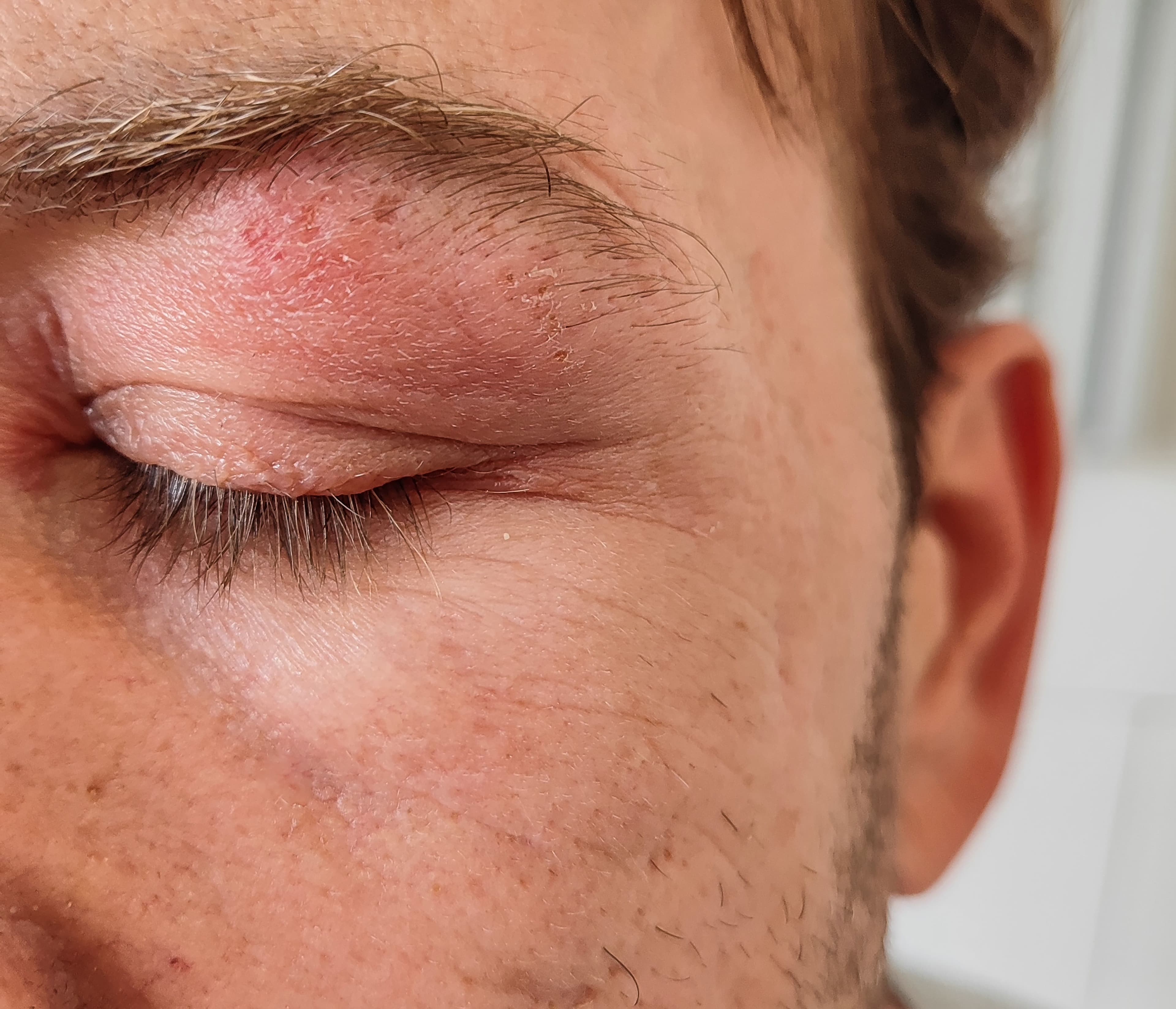 Eyes of a man suffering from herpes zoster on the 7th day of illness. inflamed eyelid and eye and forehead blisters during herpes disease. shingles on the face - Image credit: pedro | stock.adobe.com 