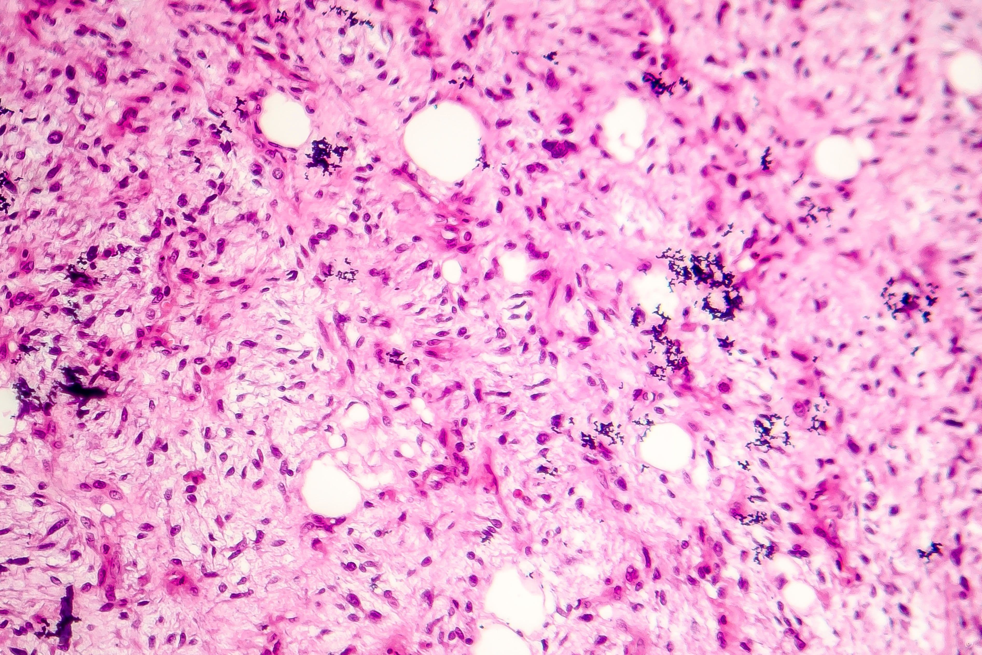 How Pharmacists Can Make an Impact When Treating Dedifferentiated Liposarcoma With Brigimadlin