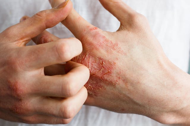 The problem with many people - eczema on hand. White background. Man itchind skin - Image credit: Ольга Тернавская | stock.adobe.com
