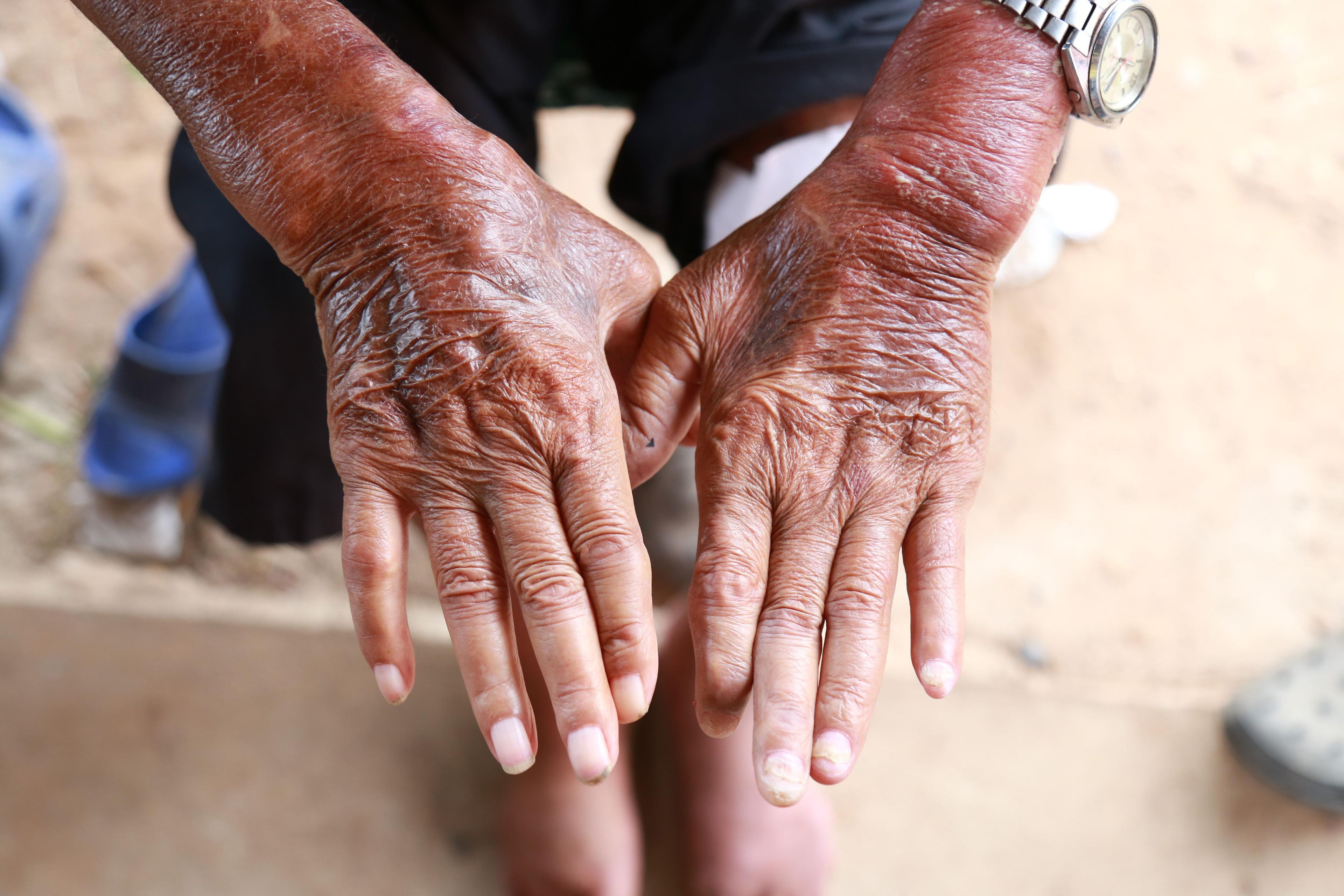 Skin disorder, pepper appearance from scleroderma, autoimmune disease male hand