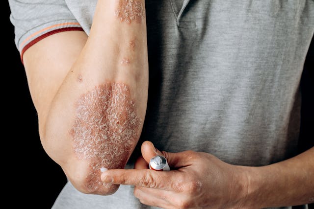 atopic dermatitis salt/Image Credit: © fusssergei - stock.adobe.com