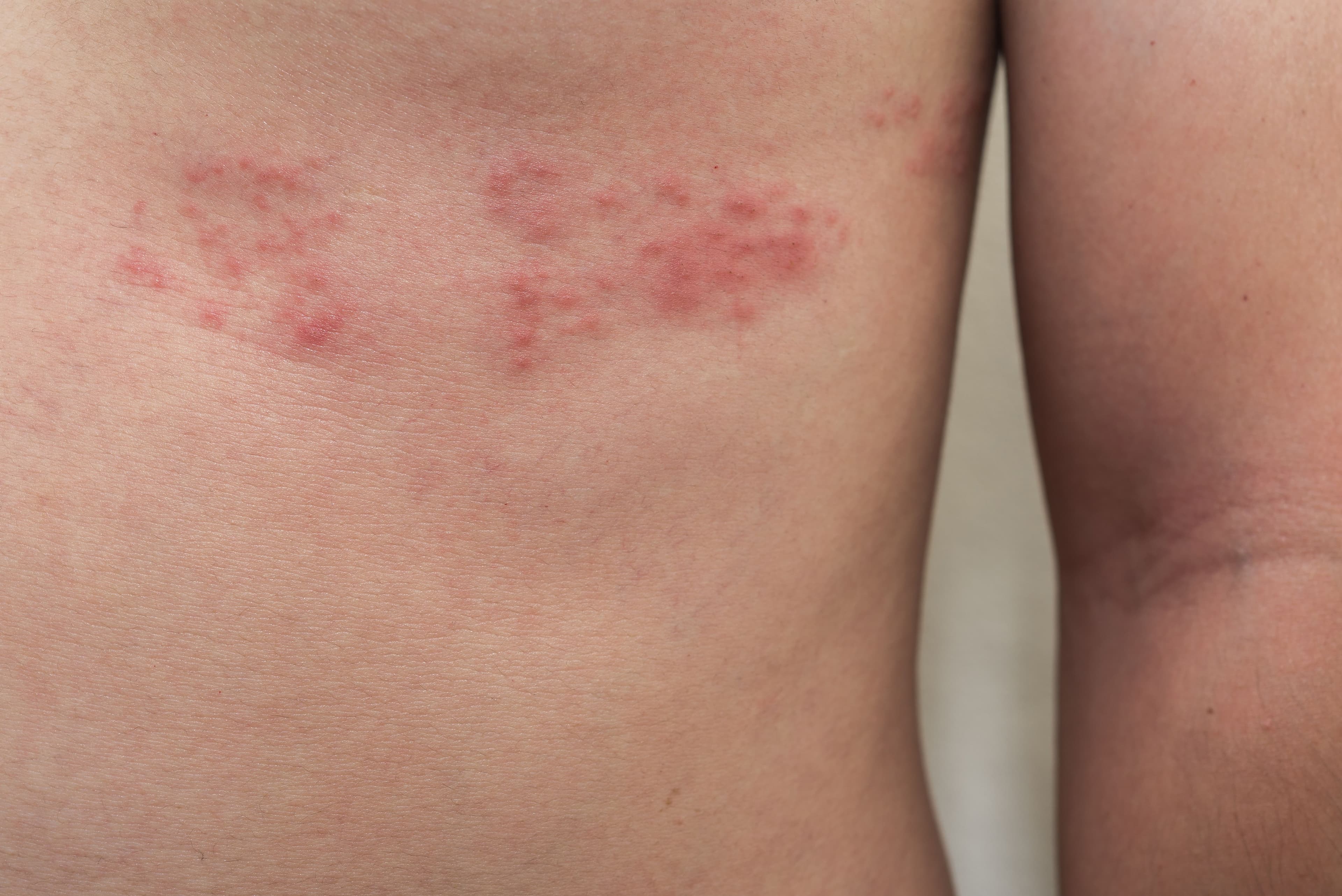 Detail of body skin with Herpes Zoster (Shingles) - Image credit: Sunday Cat Studio | stock.adobe.com