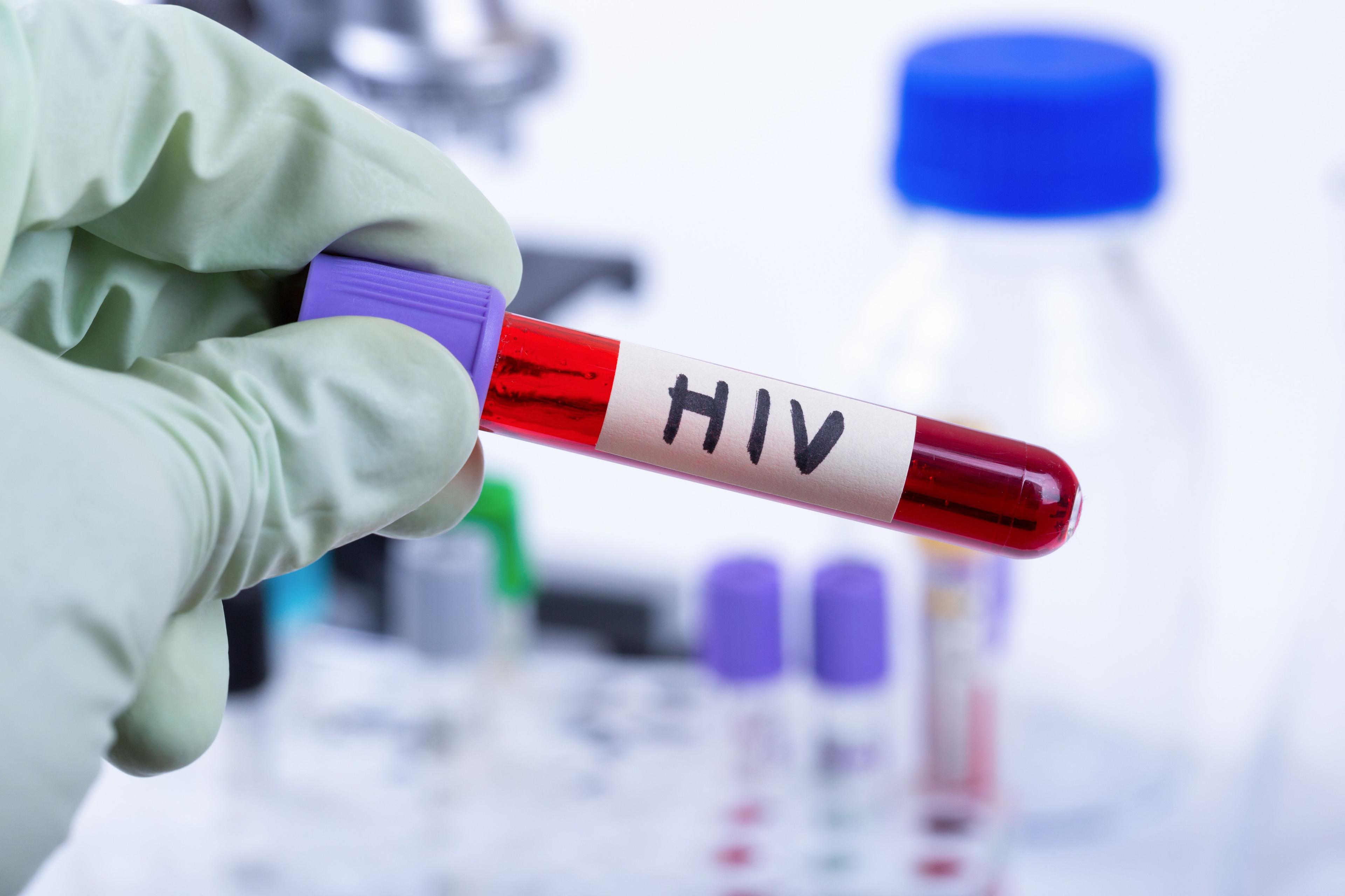 Hand holding tube with blood sample for hiv test - Image credit: ronstik | stock.adobe.com