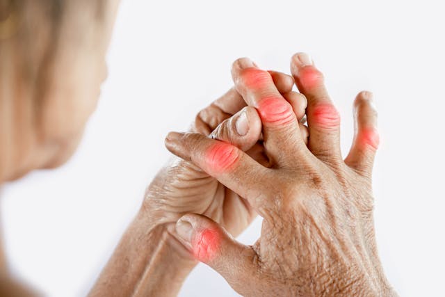 Rheumatoid Arthritis | Image Credit: doucefleur - stock.adobe.com