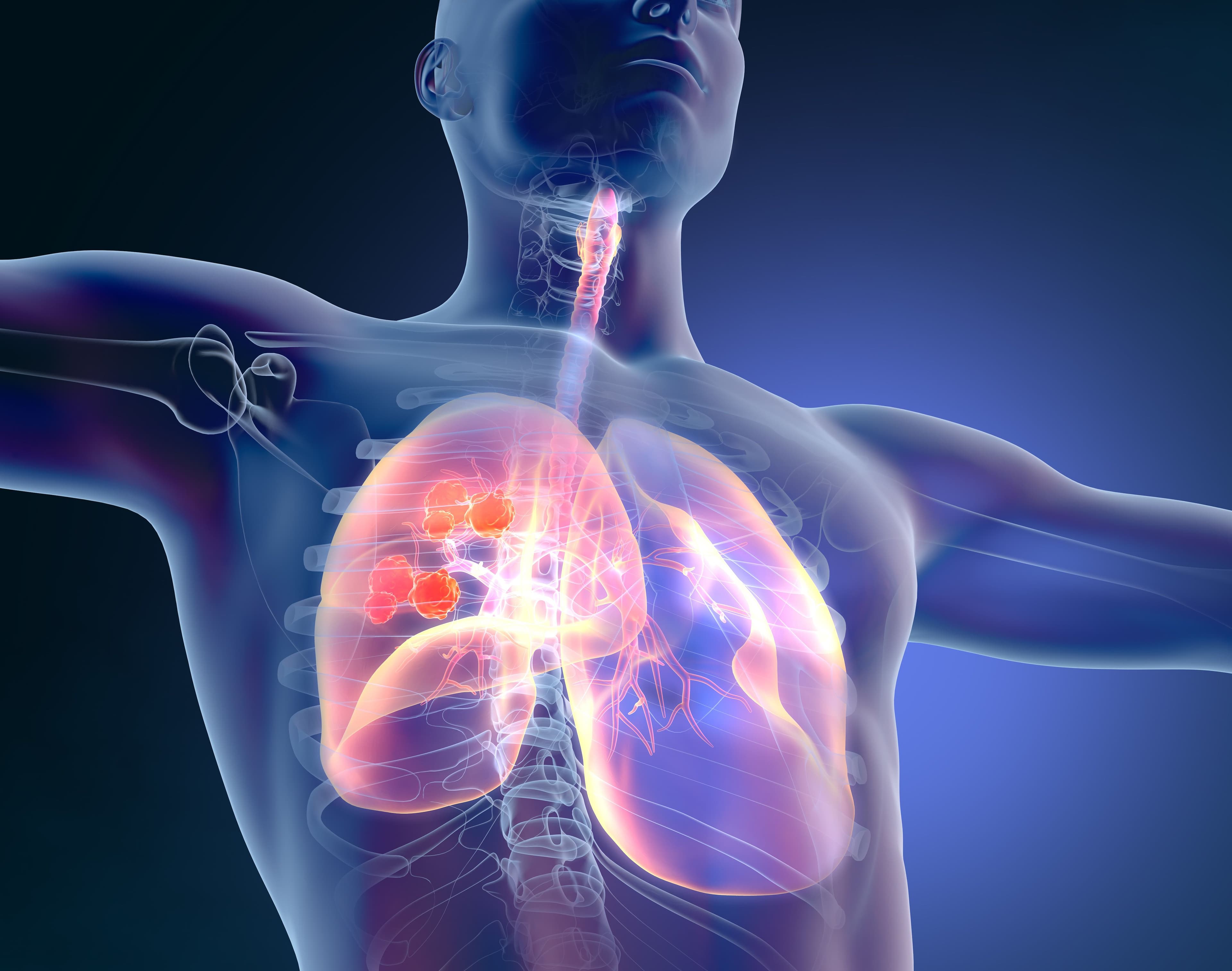 Expert Discusses Disparities in Biomarker Testing for NSCLC