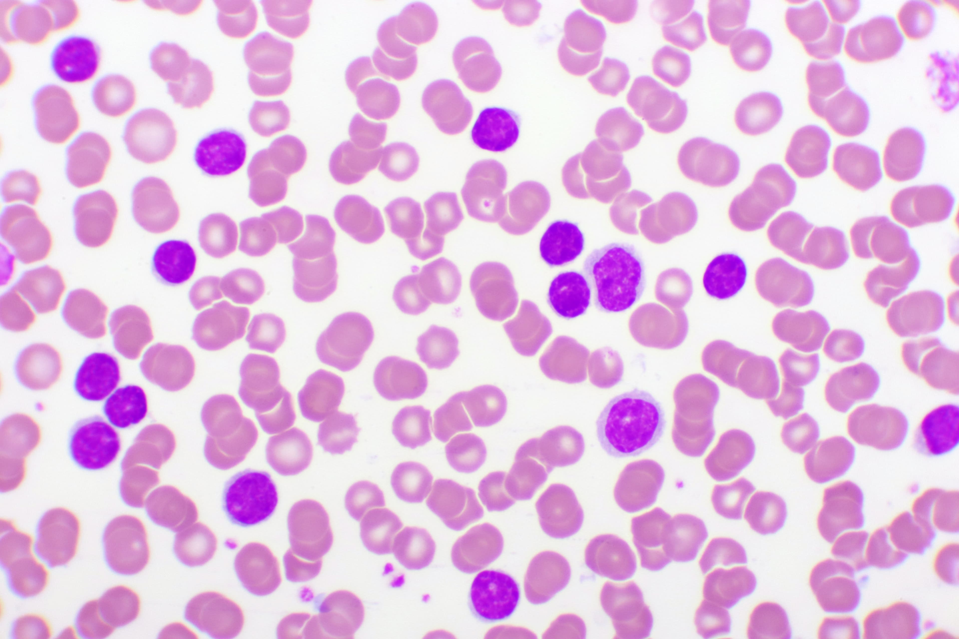 Phase 2 Trial Results Showed Venetoclax Added to CLAD/LDAC Is Highly Active as Frontline Therapy in Older Patients With Newly Diagnosed AML