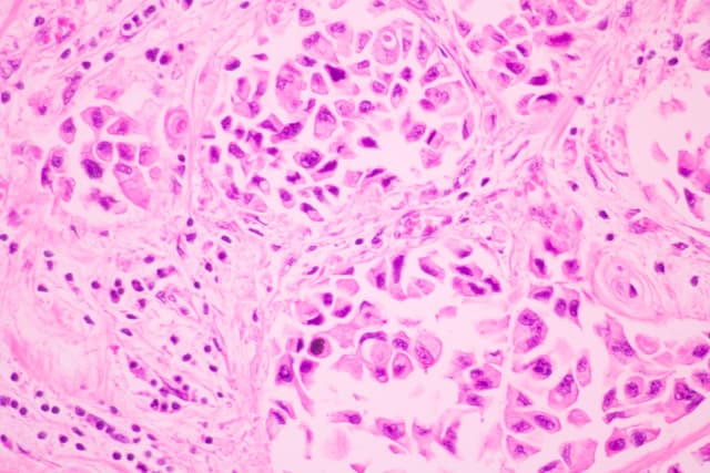 Section tissue of breast cancer view in microscopy.