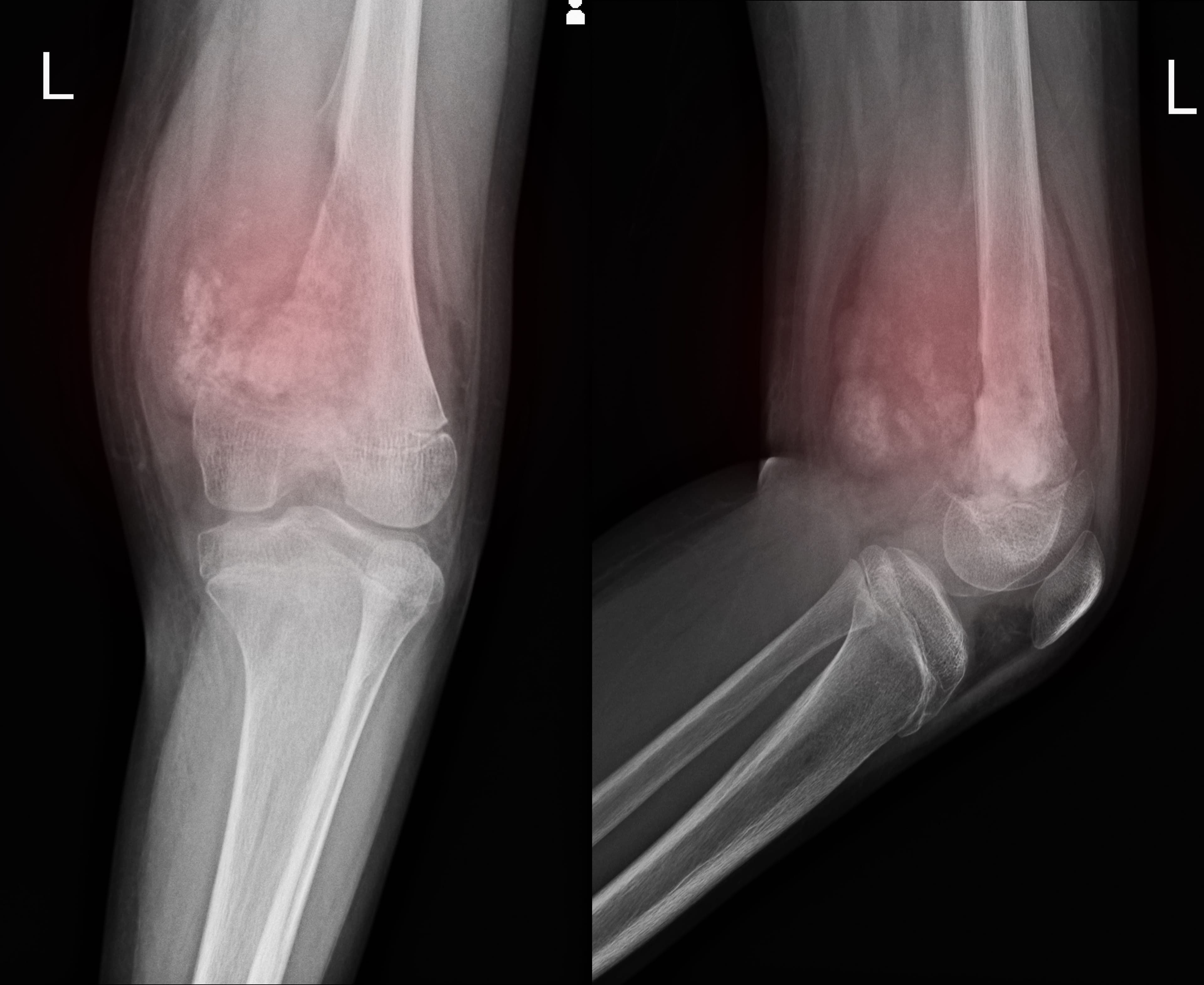 Bone Cancer, Ewing Sarcoma, Oncology, Pediatric Patients | Image Credit: © Richman Photo | stock.adobe.com