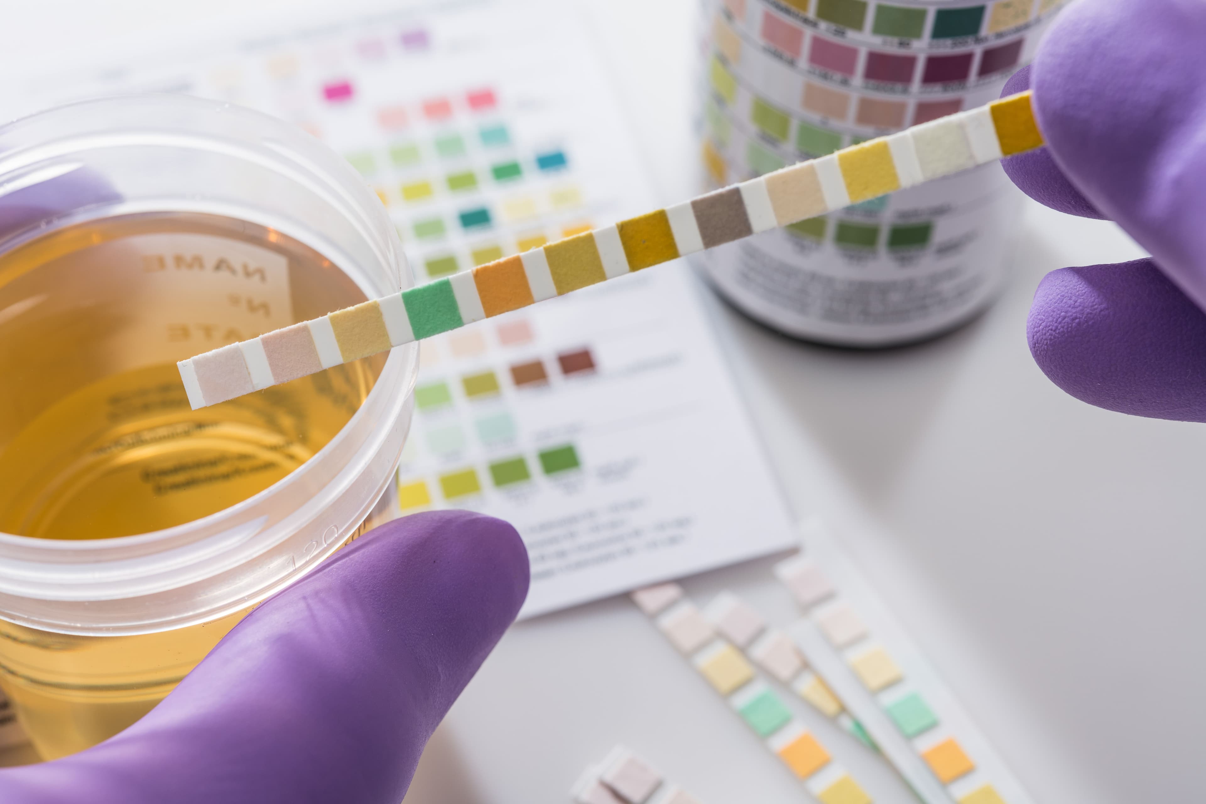 urine test strips in purple gloves - Image credit: Lothar Drechsel | stock.adobe.com