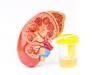 Diabetic Kidney Disease Rates Unchanged Over 30 Years