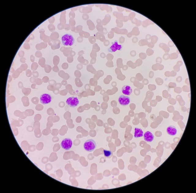 AI Model Can Differentiate Prefibrotic Primary Myelofibrosis From Essential Thrombocythemia With High Accuracy