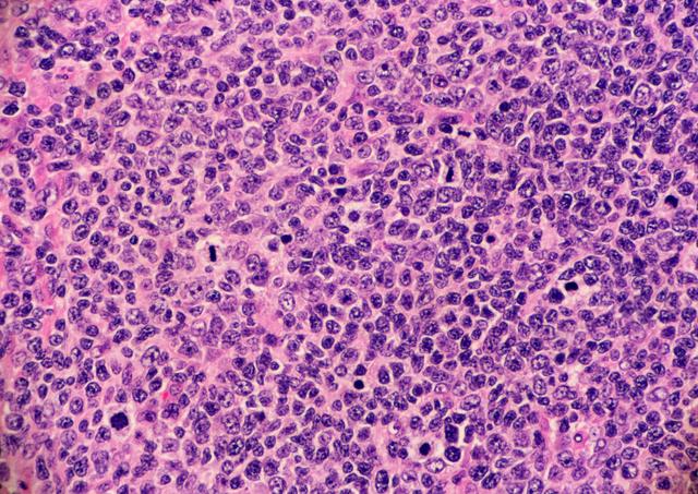 Follicular lymphoma -- Image credit: Lisa | stock.adobe.com