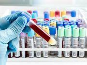 Blood Test Could Determine Prostate Cancer Treatment Efficacy