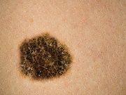 Skin Cancer Combination Therapy Shows Promise