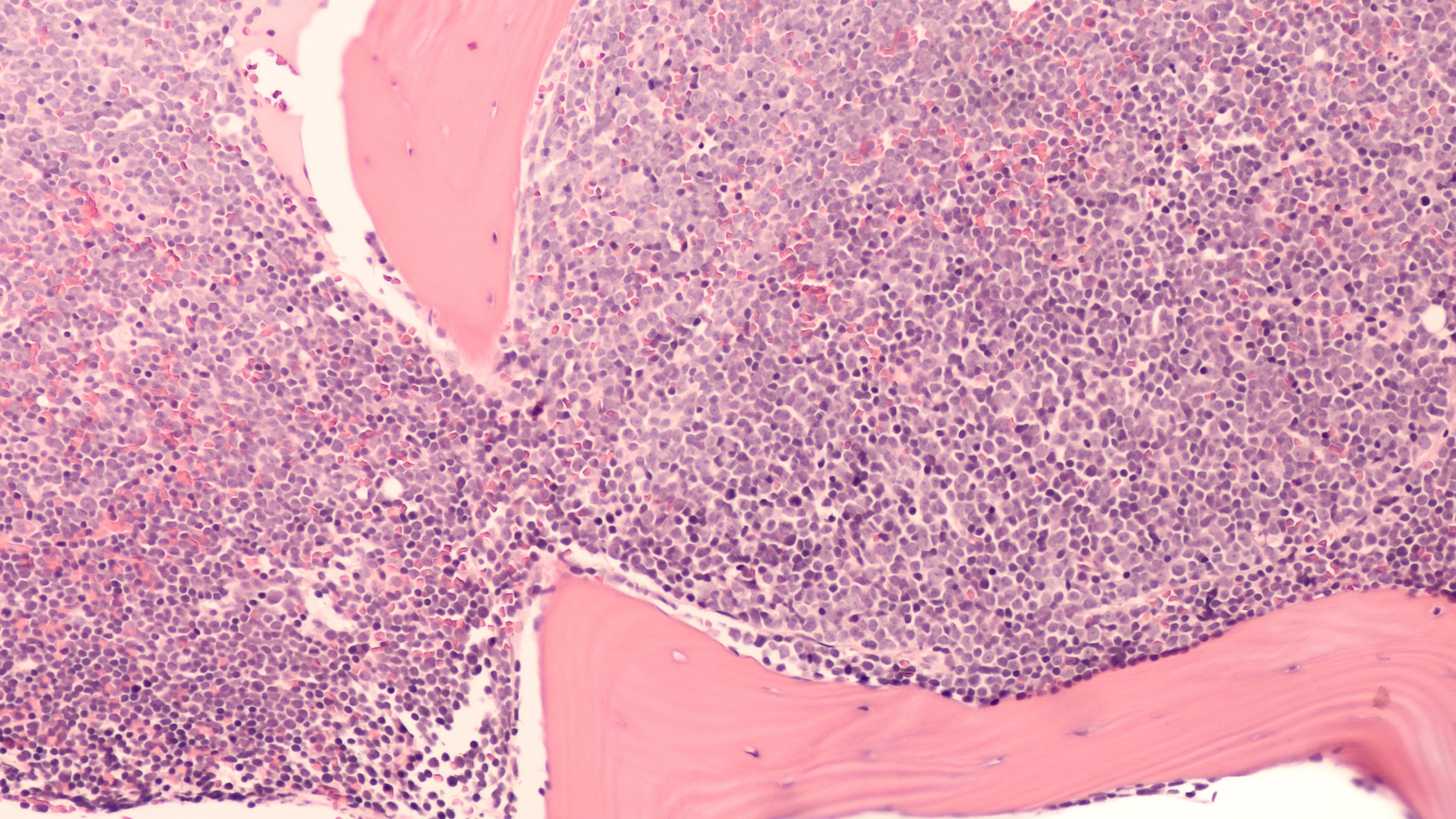 A staging bone marrow biopsy shows replacement of normal elements by diffuse large B-cell lymphoma, a type of non Hodgkin lymphoma