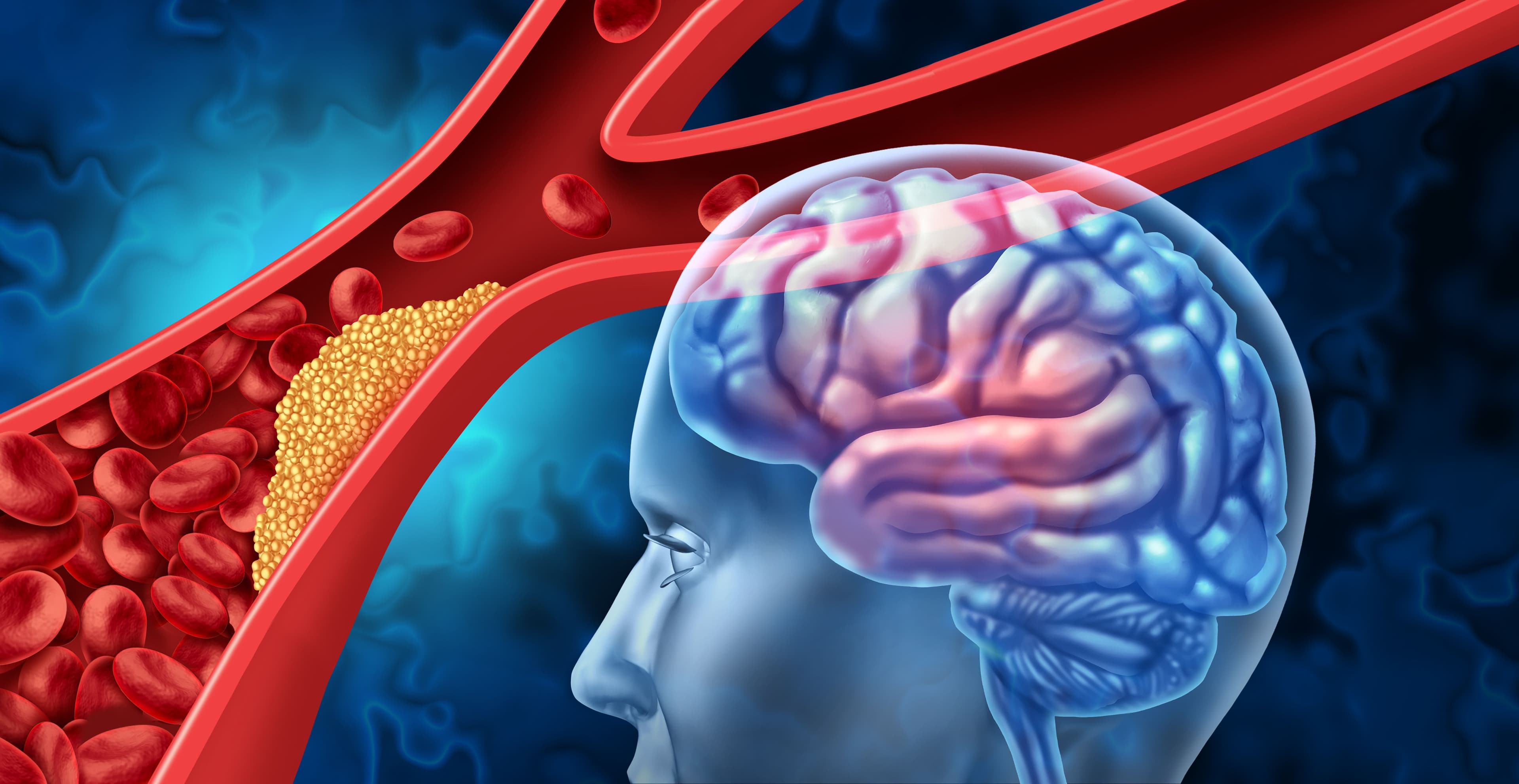 stroke and cholesterol