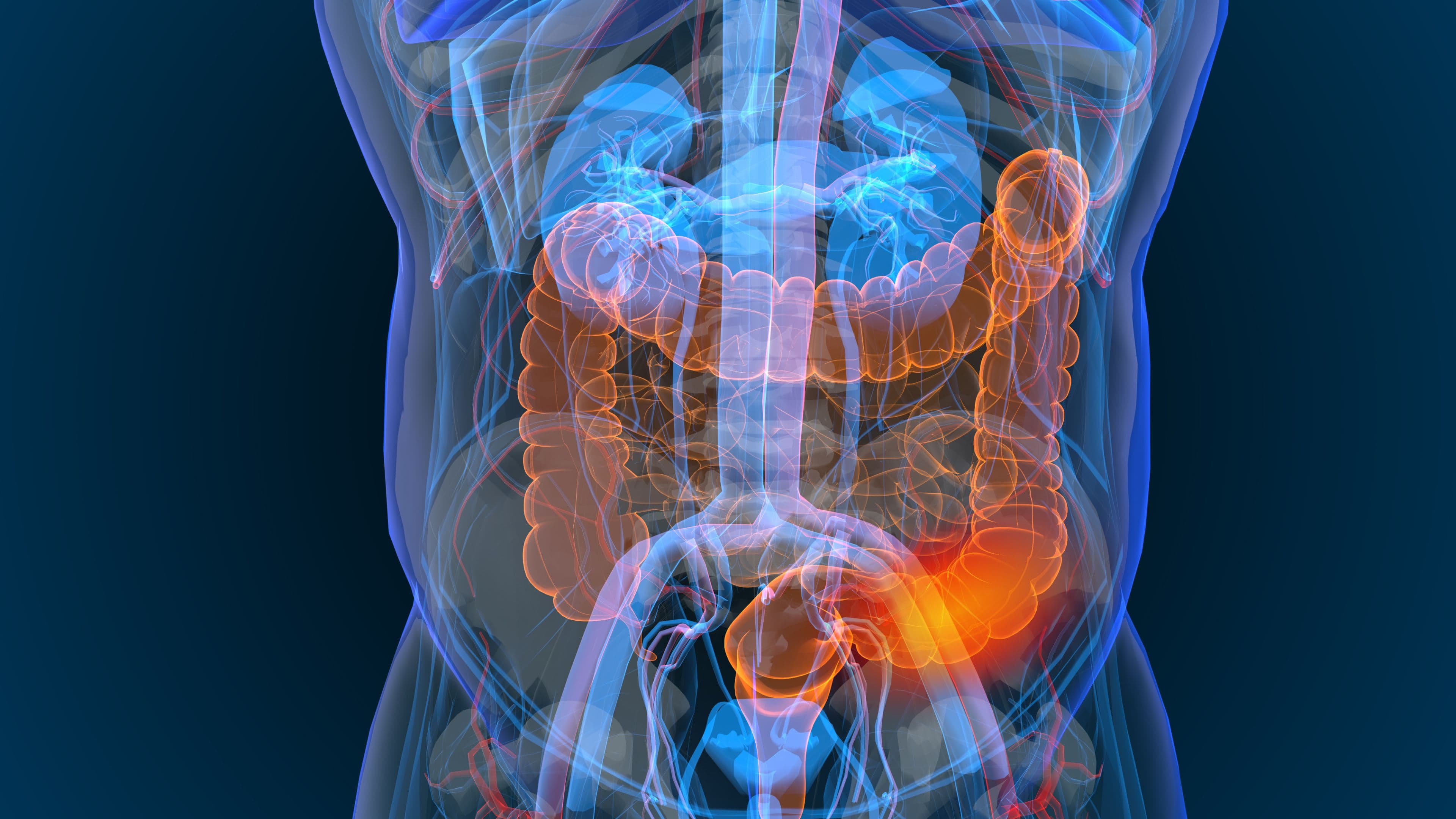 3d rendered illustration of bowel cancer 3D illustration - Image credit: appledesign | stock.adobe.com