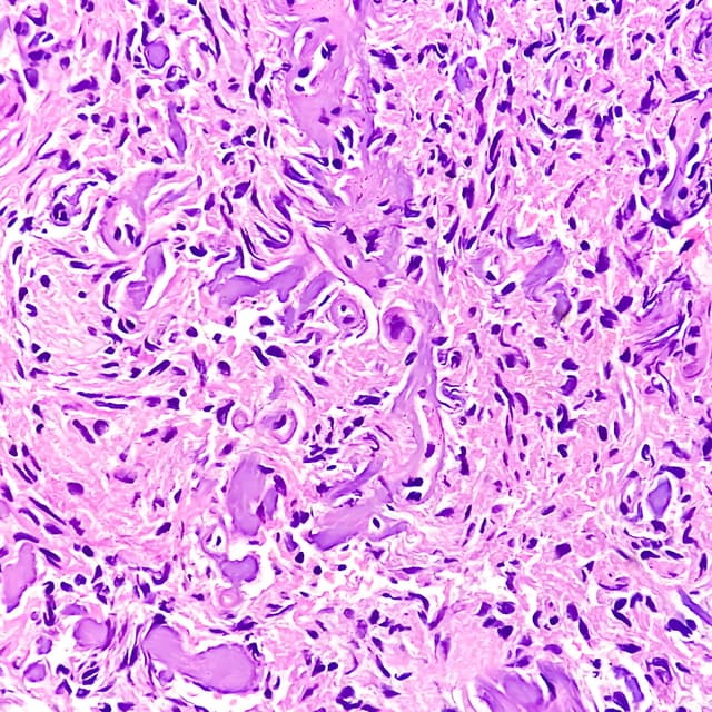 Photomicrograph: Meningioma, the most common type of primary brain tumor