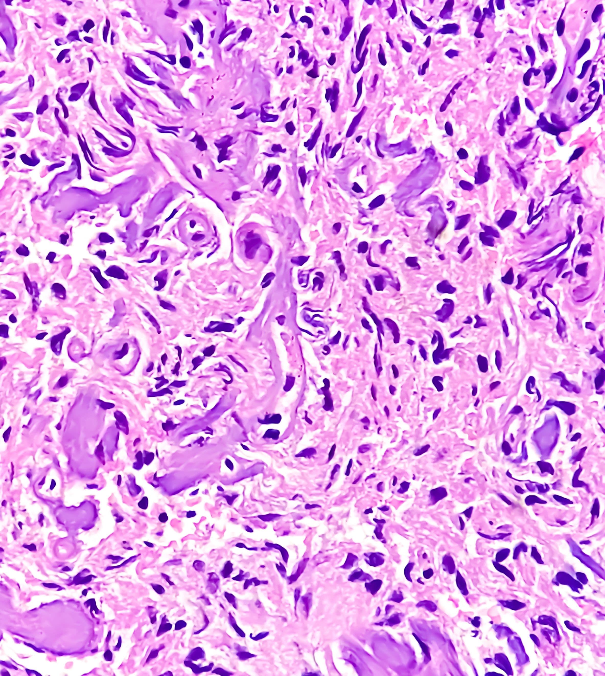 Photomicrograph: Meningioma, the most common type of primary brain tumor