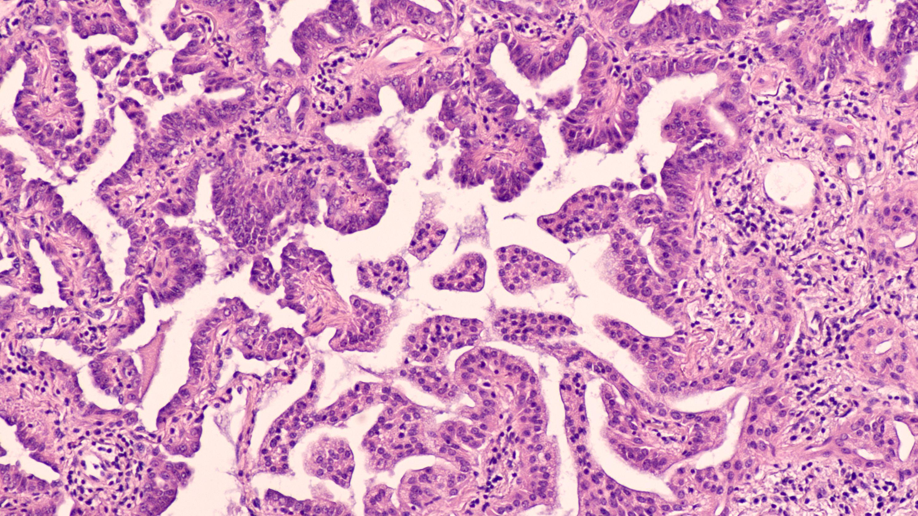 Adenocarcinoma in situ of lung