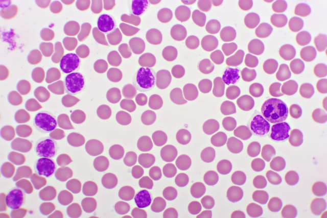 Acute lymphocytic leukemia -- Image credit: jarun011 | stock.adobe.com