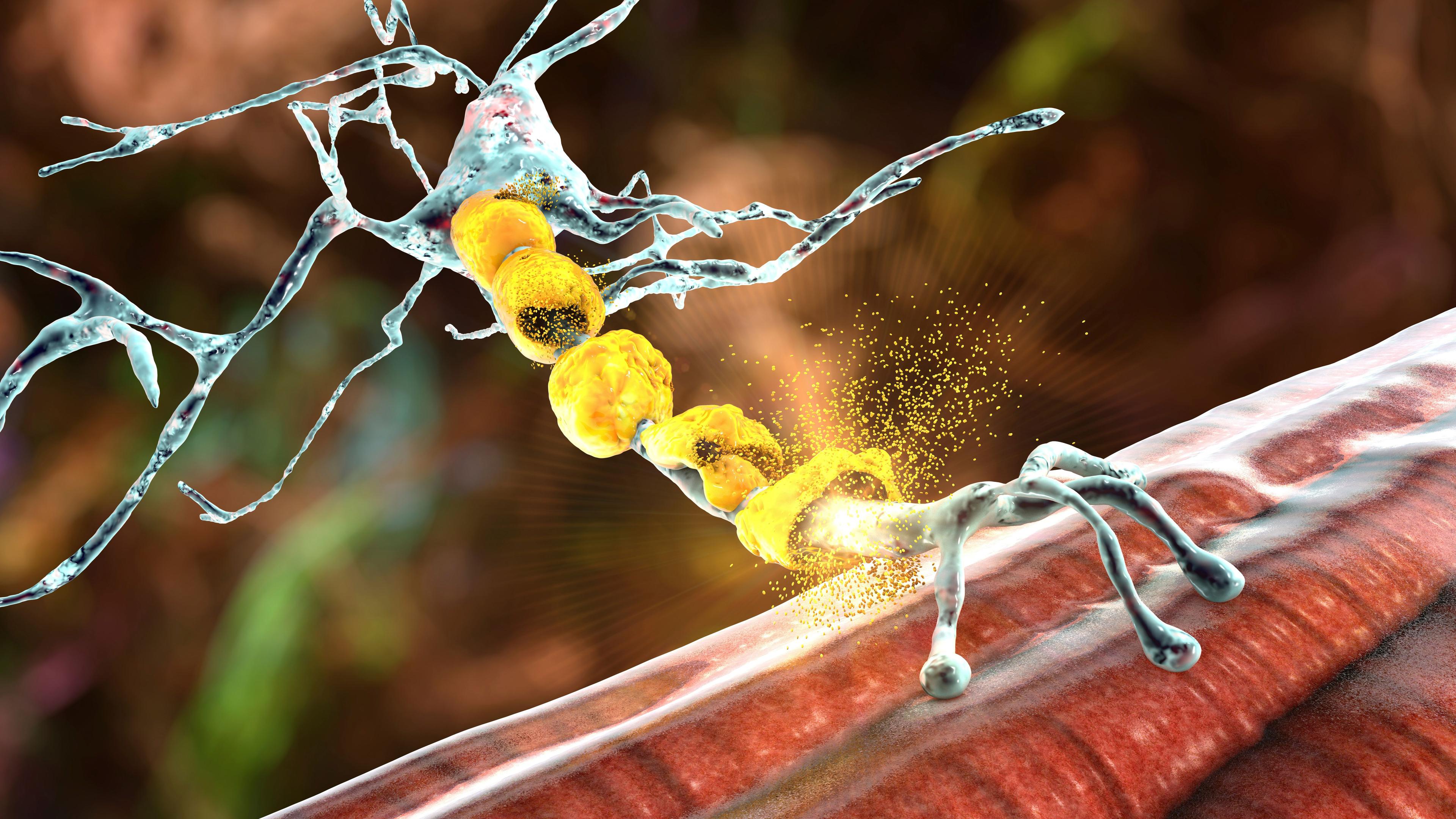 Damage of the neuron myelin sheath seen in demyelinating diseases