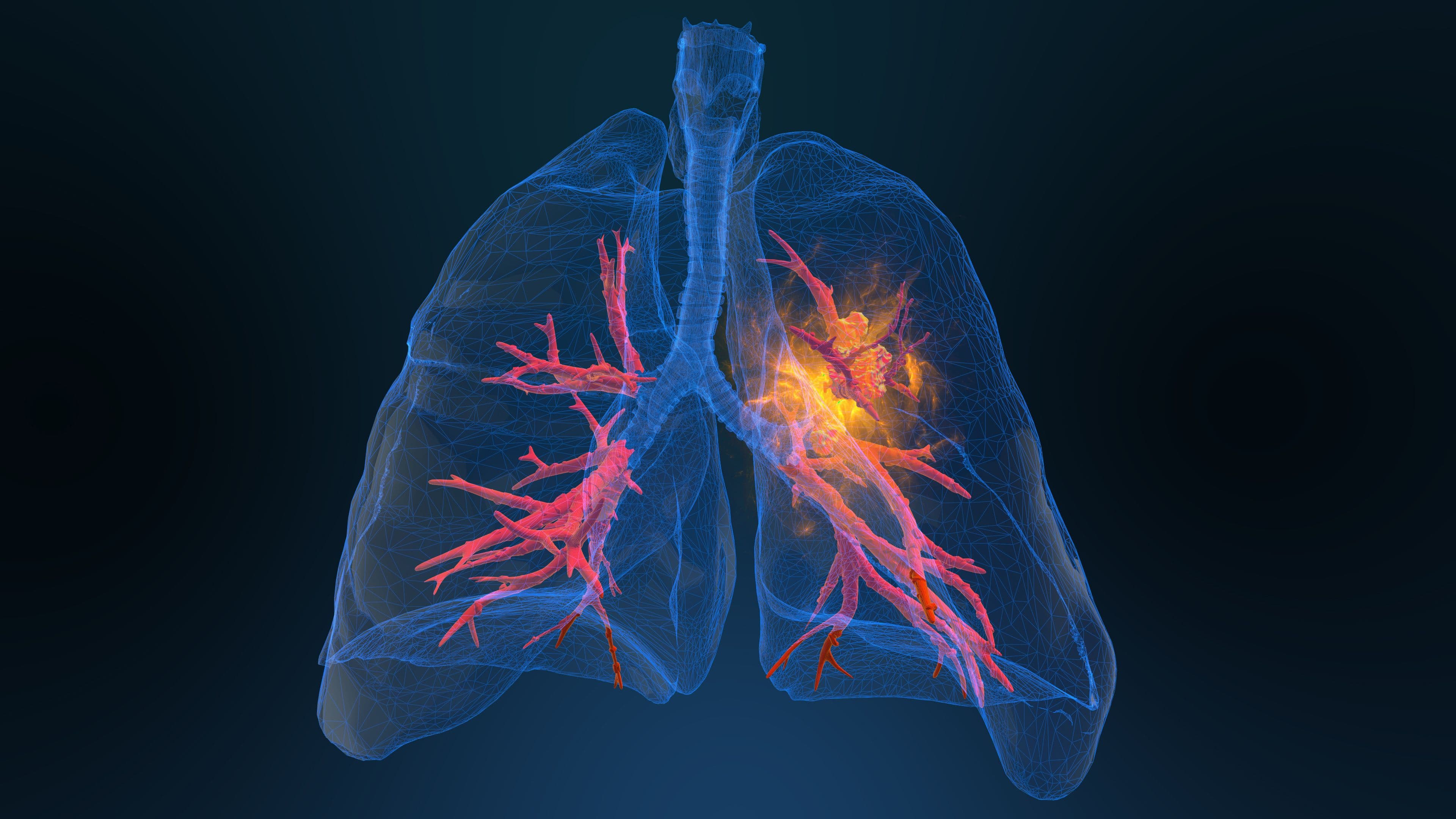 Expert: PALOMA-3 Trial Results, Benefits of Subcutaneous Amivantamab for Lung Cancer Treatment