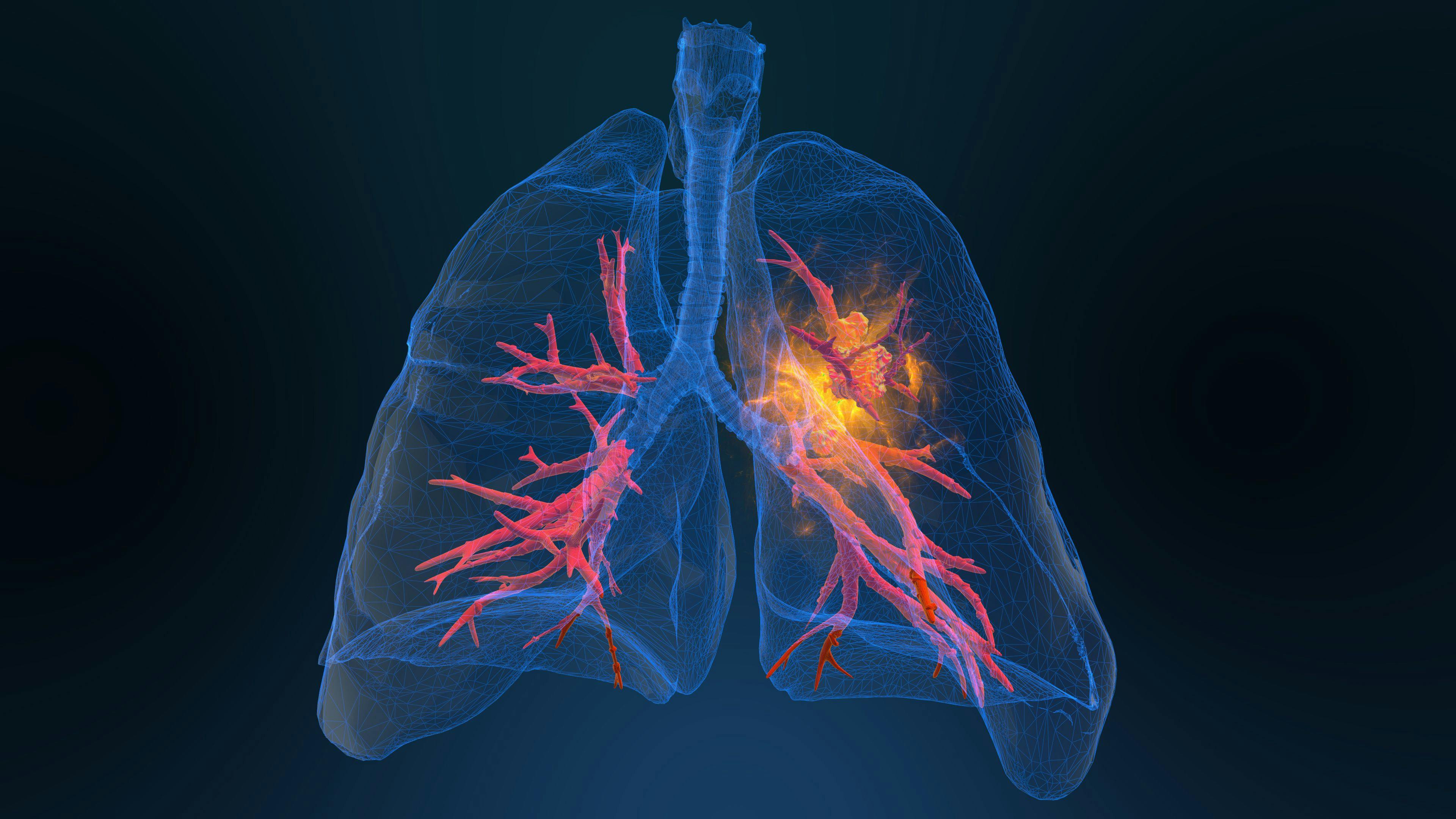 Lung Cancer, Small Cell Lung Cancer | Image Credit: appledesign - stock.adobe.com